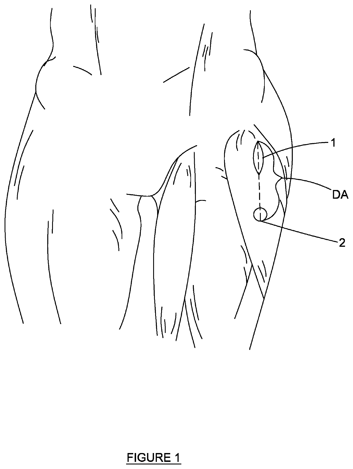 Anterior Portal Assisted Total Hip Arthroplasty