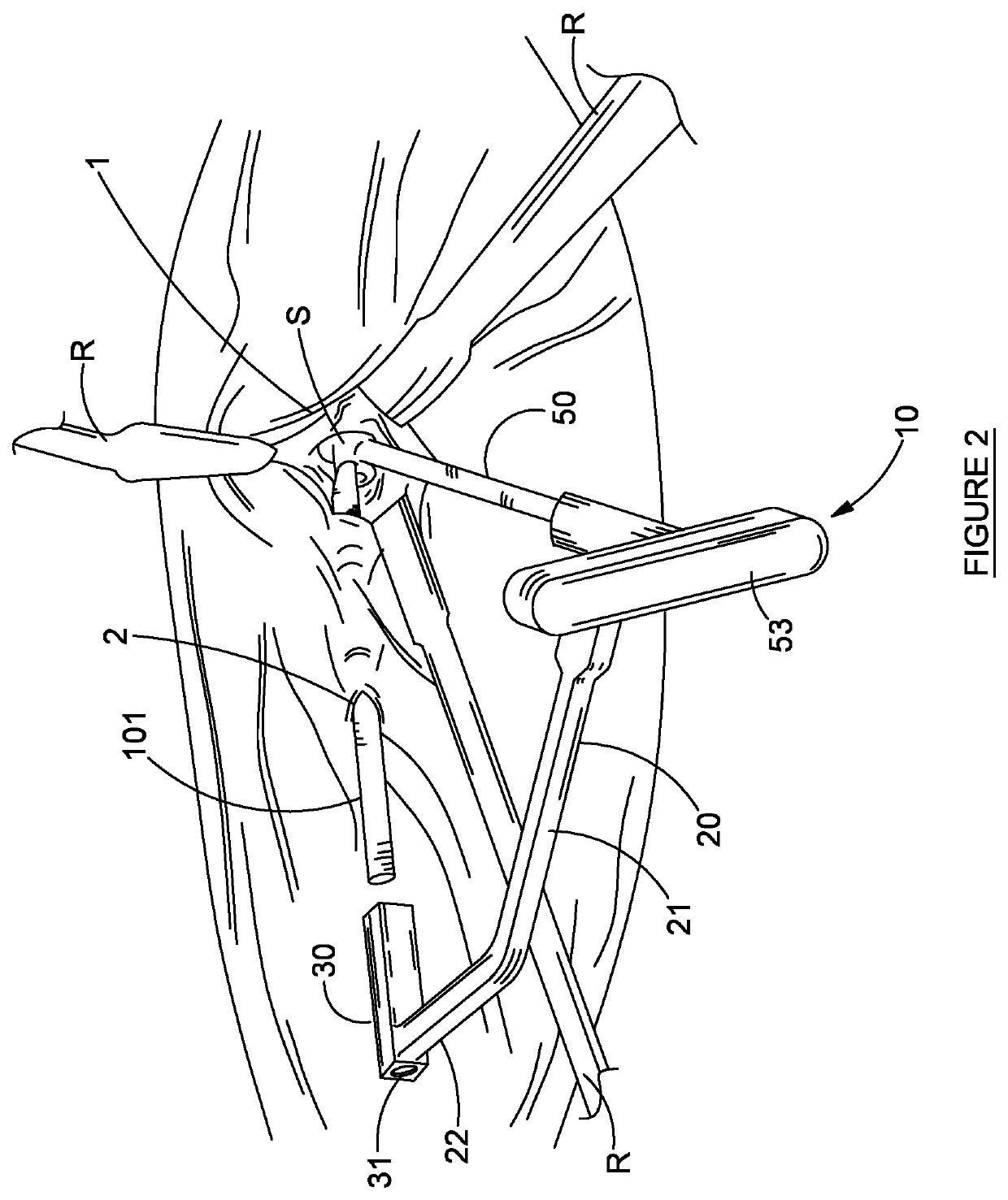 Anterior Portal Assisted Total Hip Arthroplasty