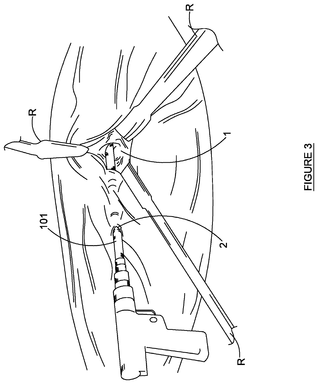 Anterior Portal Assisted Total Hip Arthroplasty