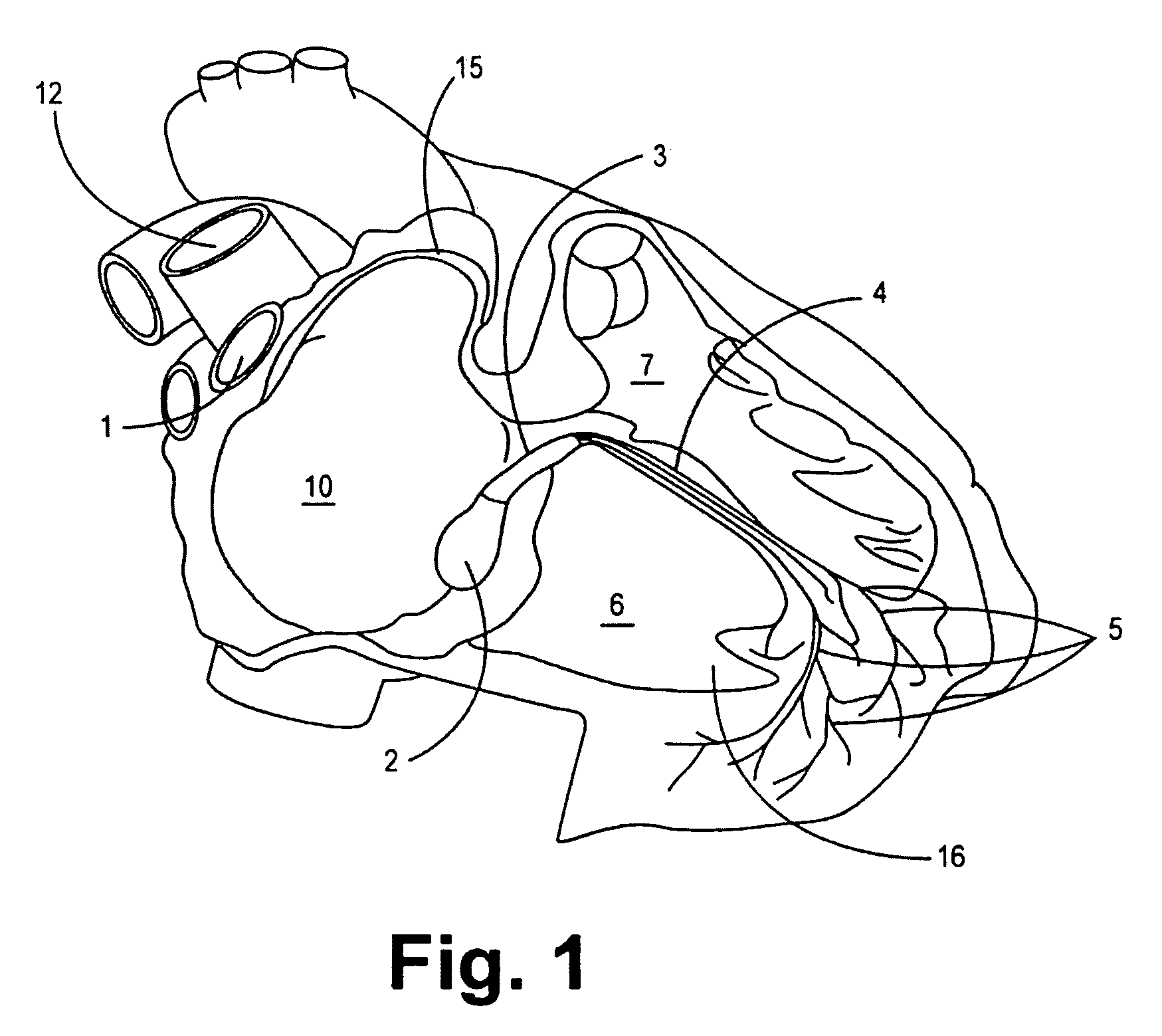 Pacing method