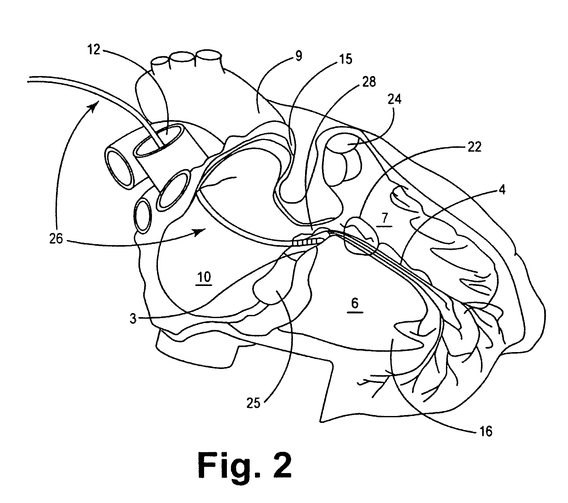 Pacing method