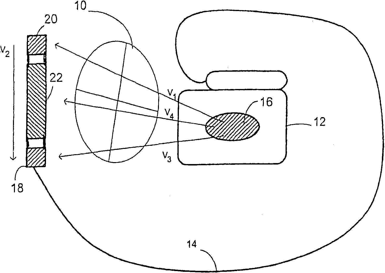 Method for discriminating between ventricular and supraventricular arrhythmias