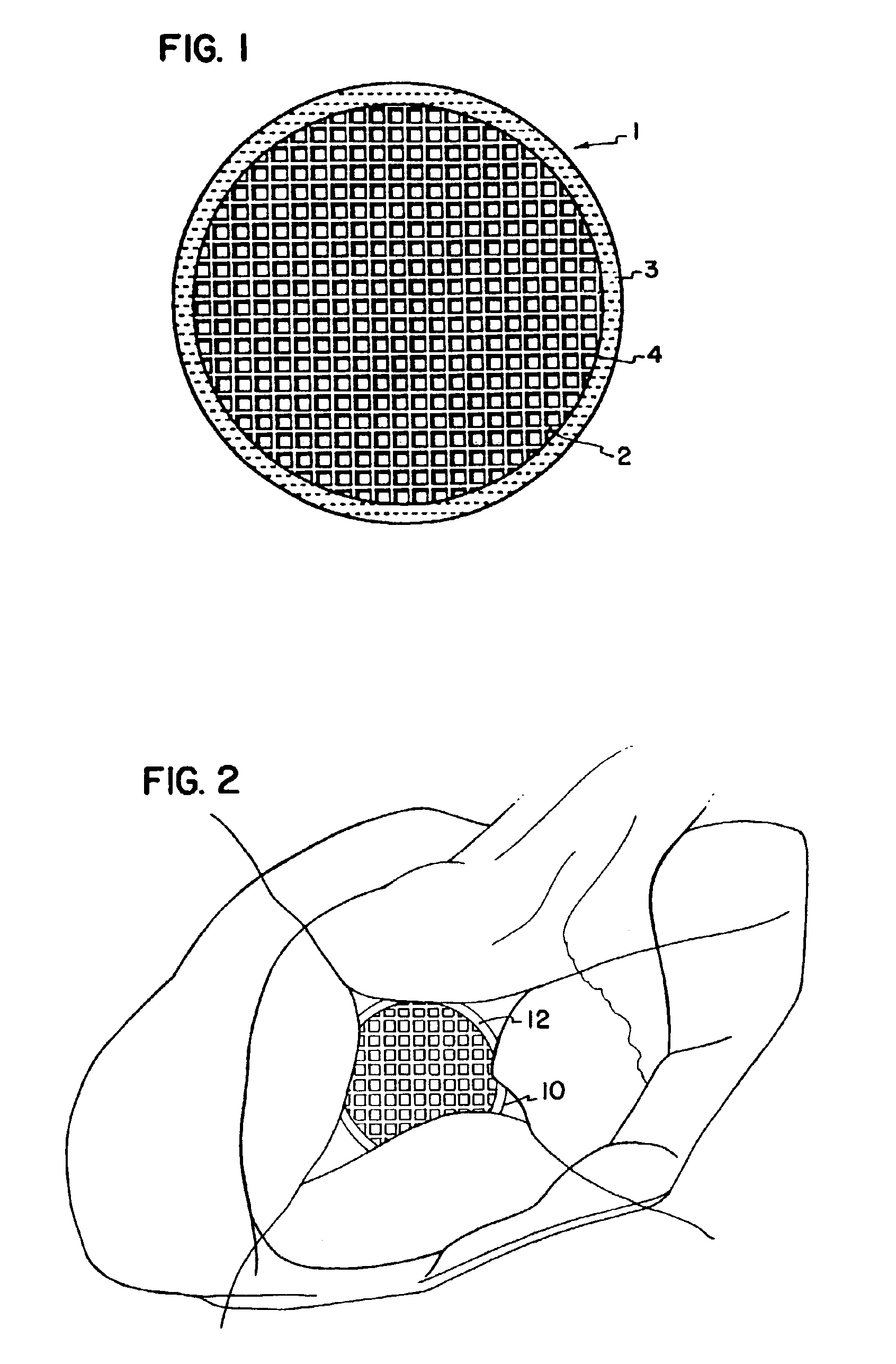 Cardiac reinforcement device