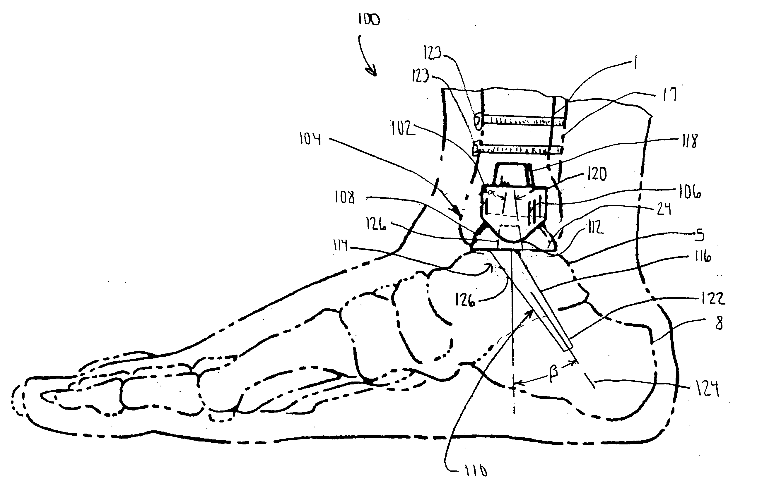 Modular ankle prosthesis and associated method