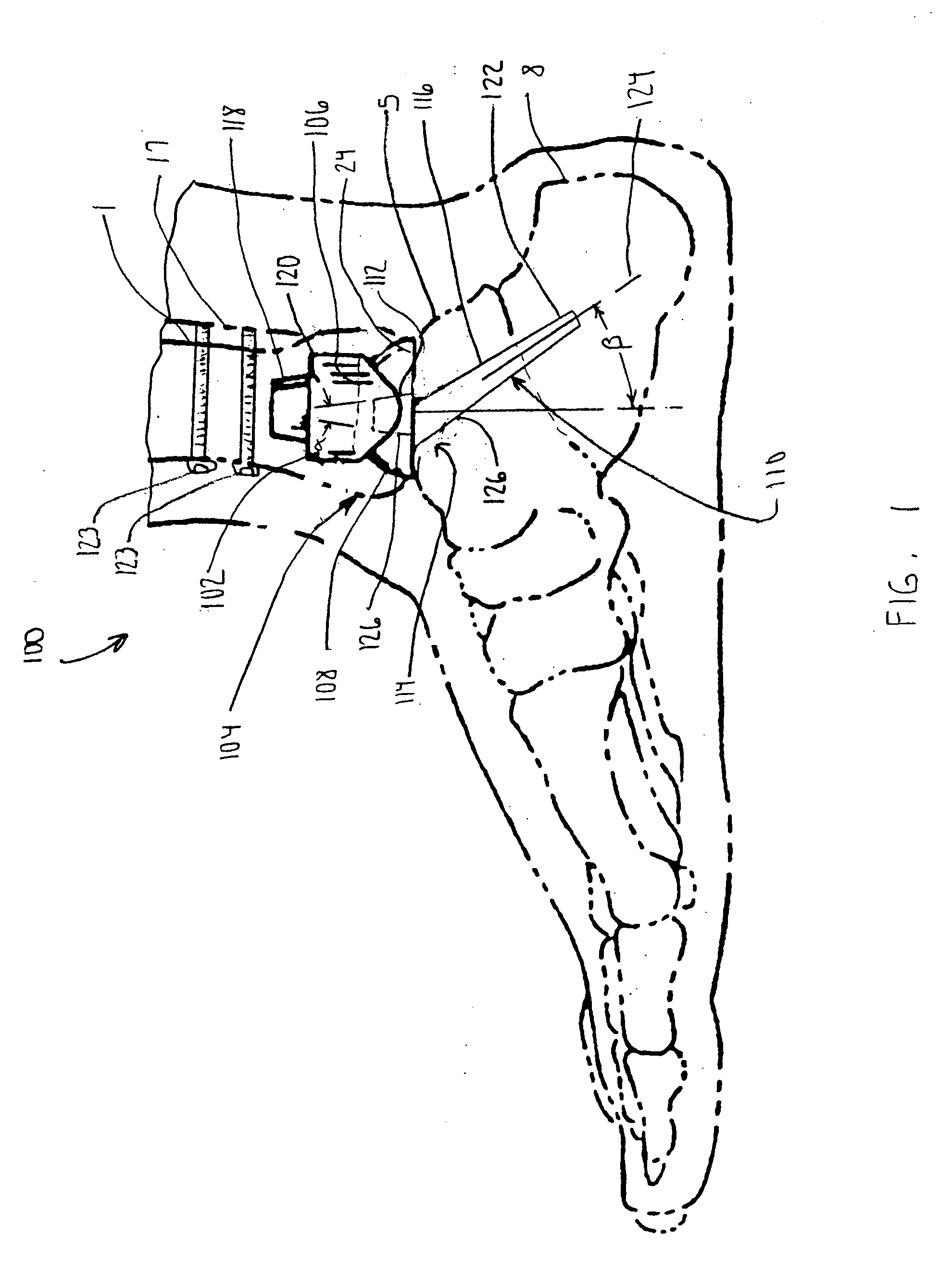 Modular ankle prosthesis and associated method