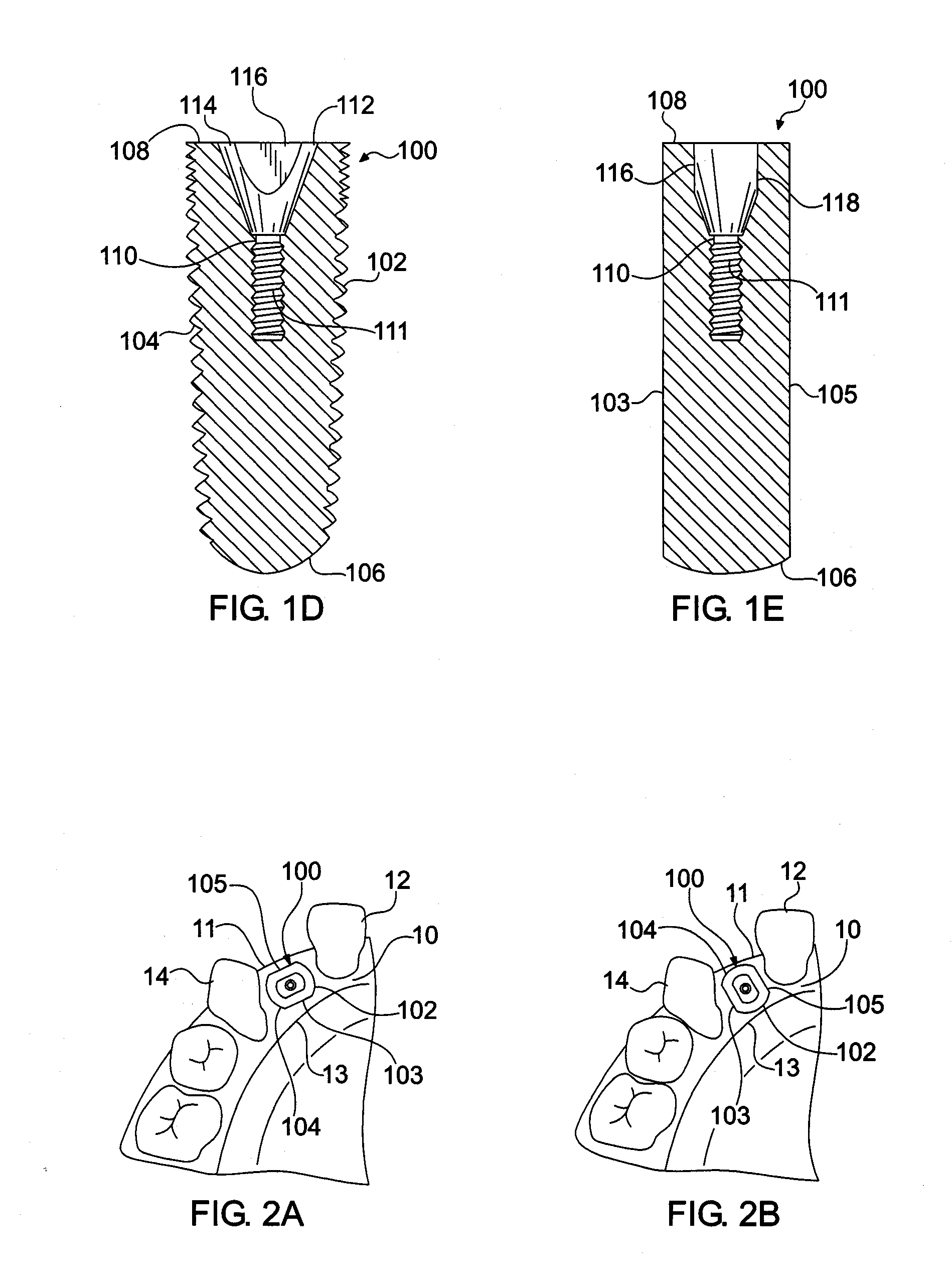 Endosseous dental implant and abutment for prevention of bone loss