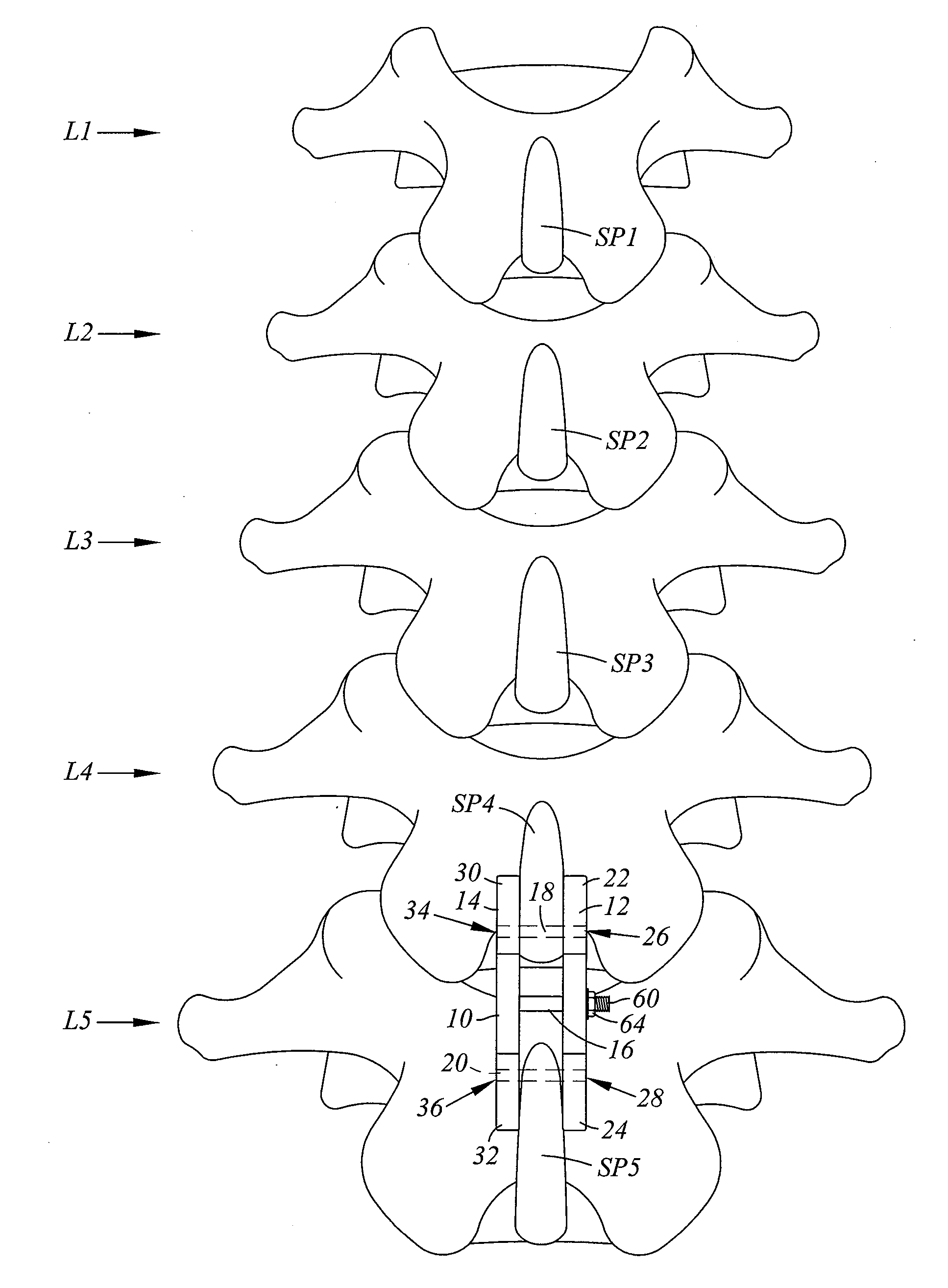 Spinal implant device with fixation plates and lag screws and method of implanting