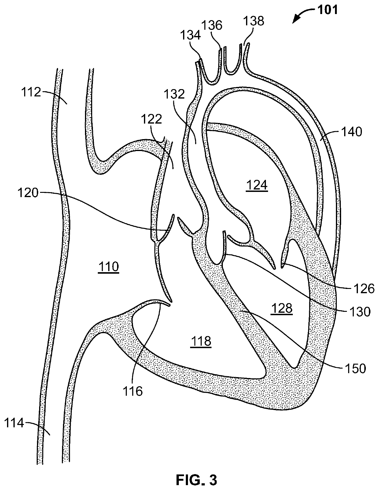 TAVR Guidewire