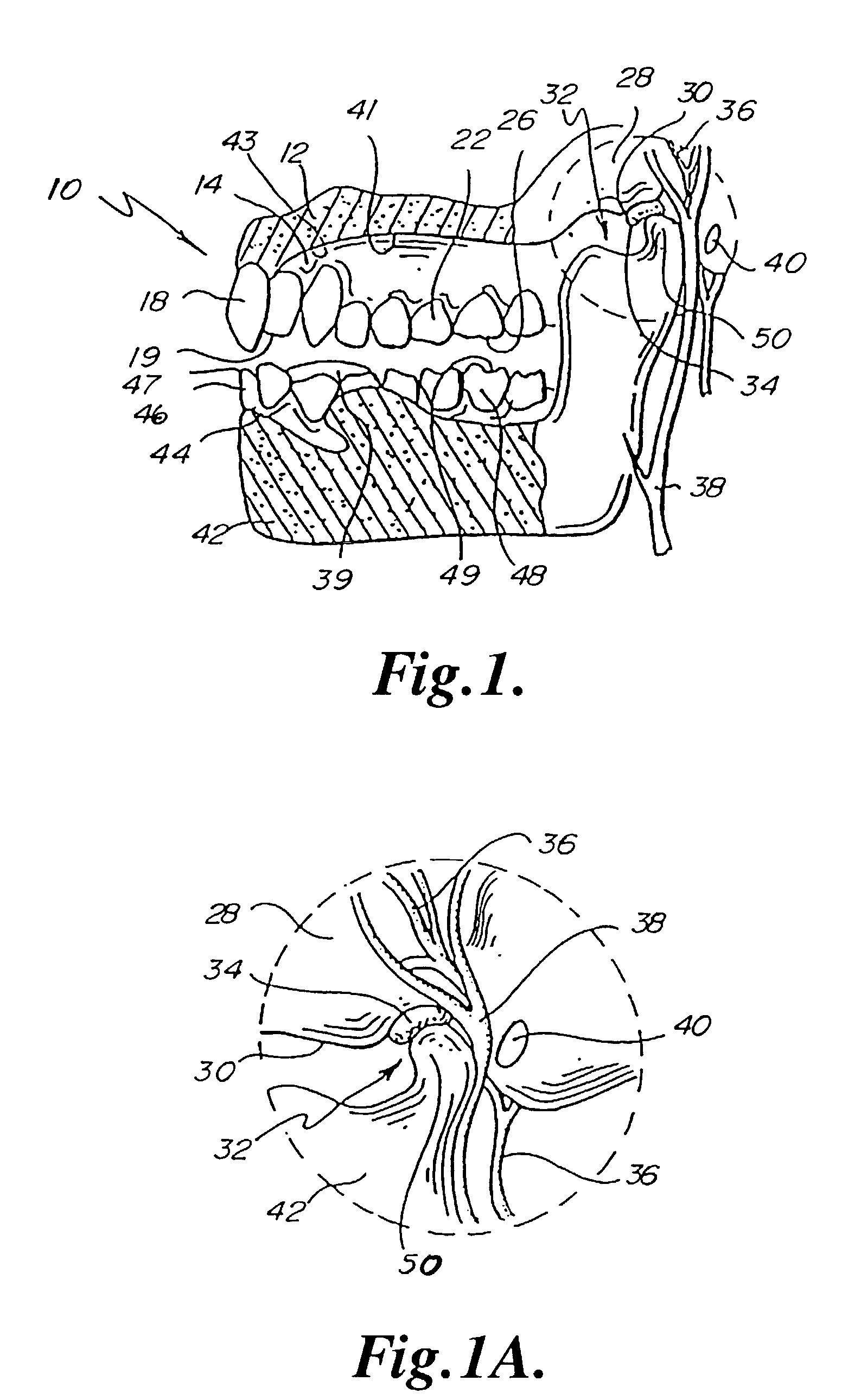 Composite performance enhancing tethered mouthguard