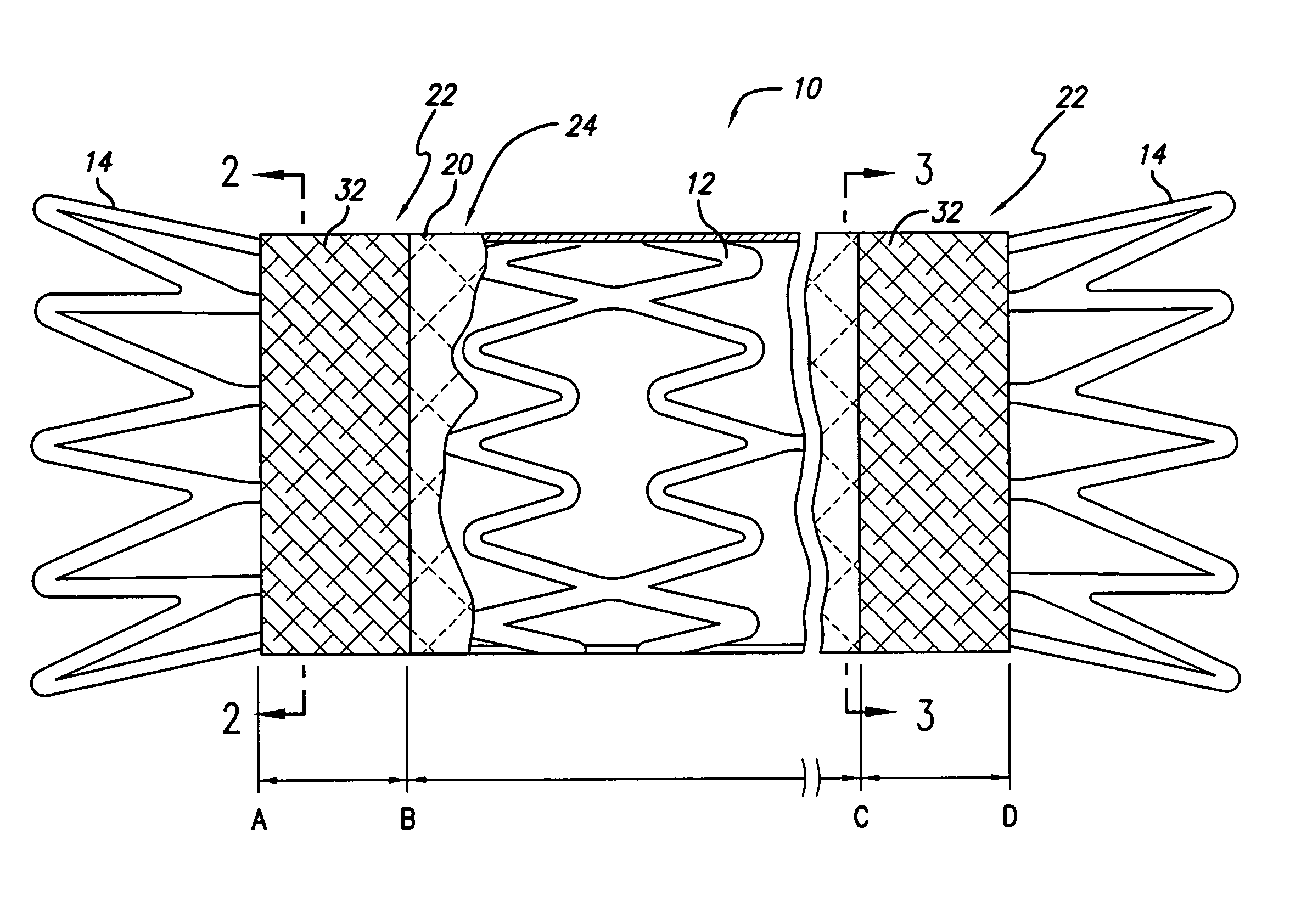 Covered stent with encapsulated ends