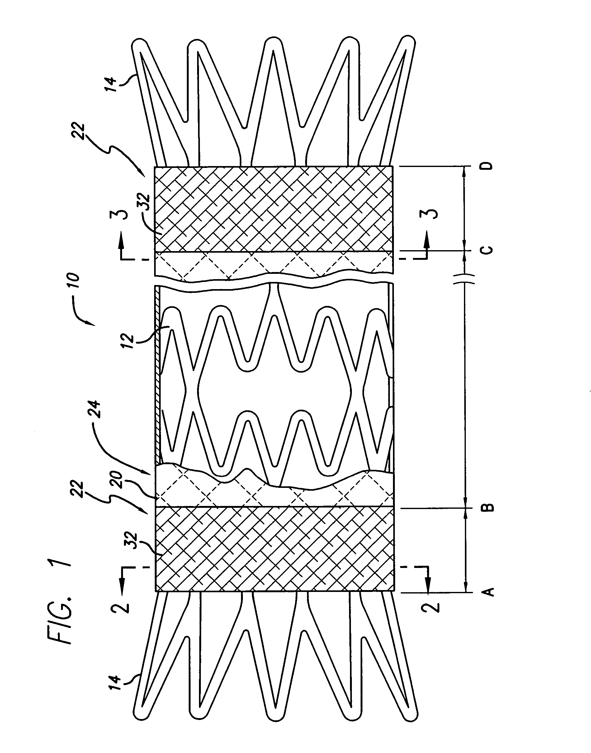 Covered stent with encapsulated ends