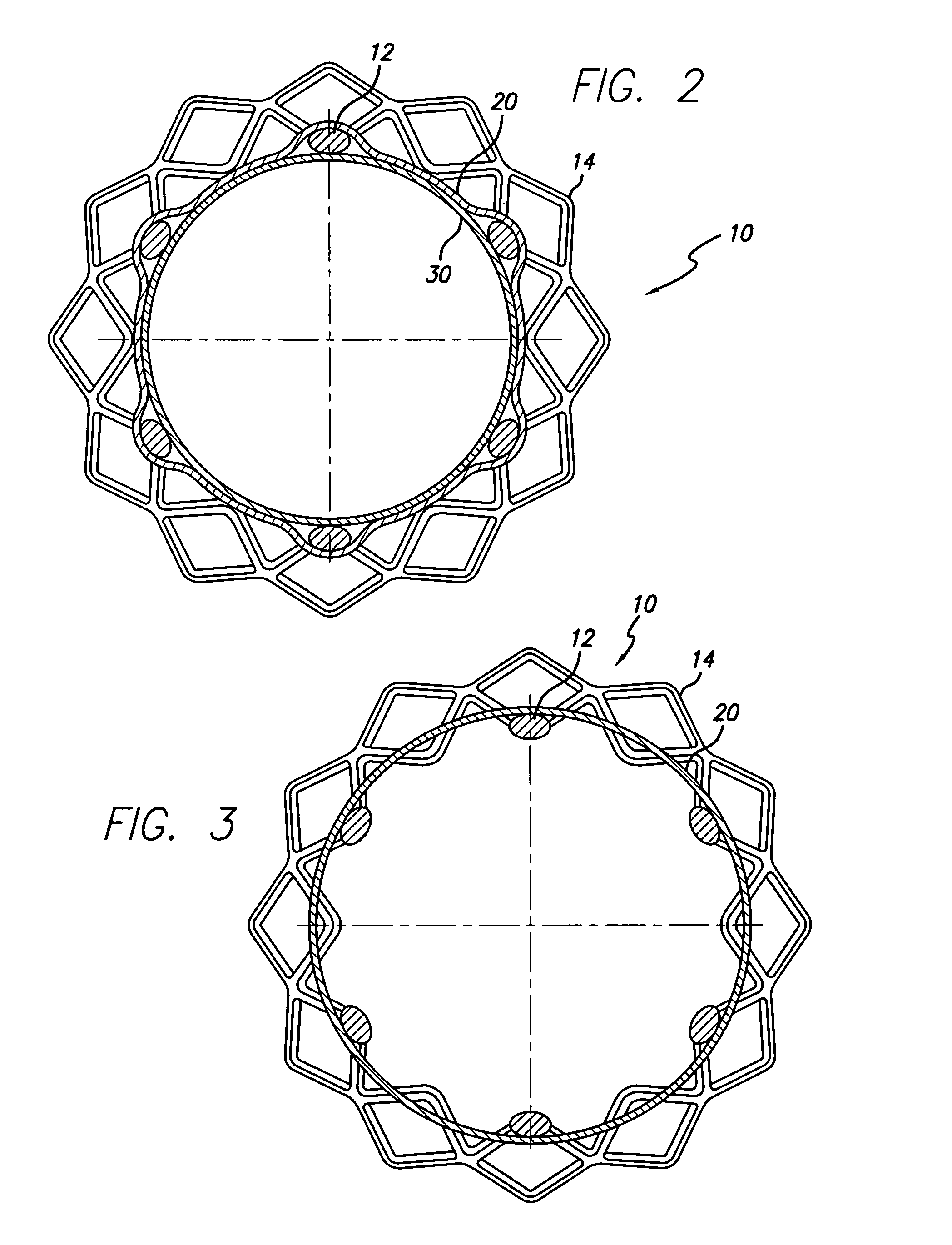 Covered stent with encapsulated ends