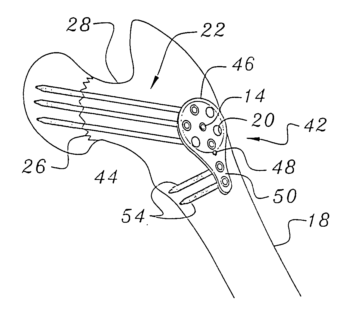 Bone end (epiphysis) fracture fixation device and method of use