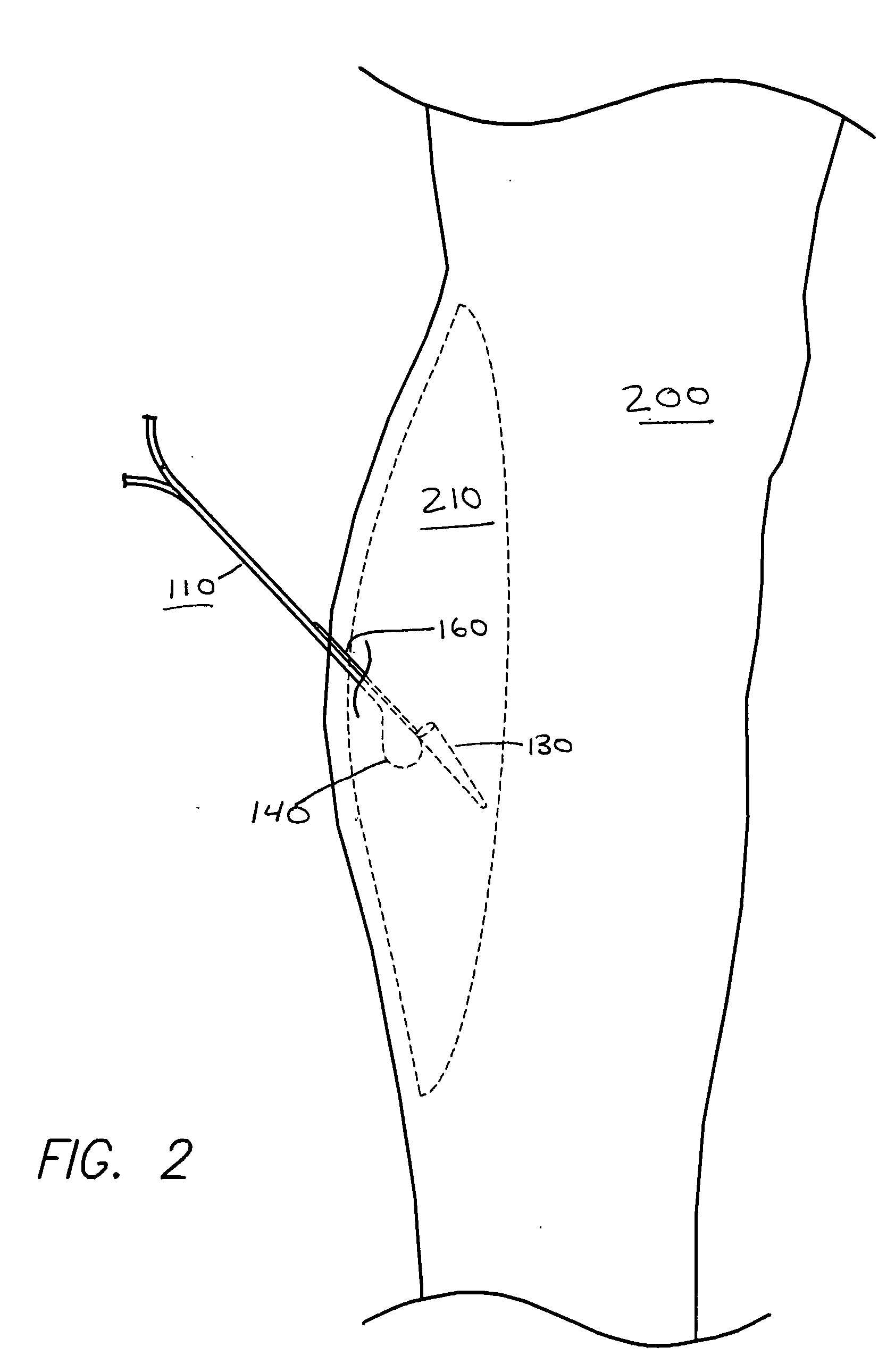 Continuous compartment pressure monitoring device