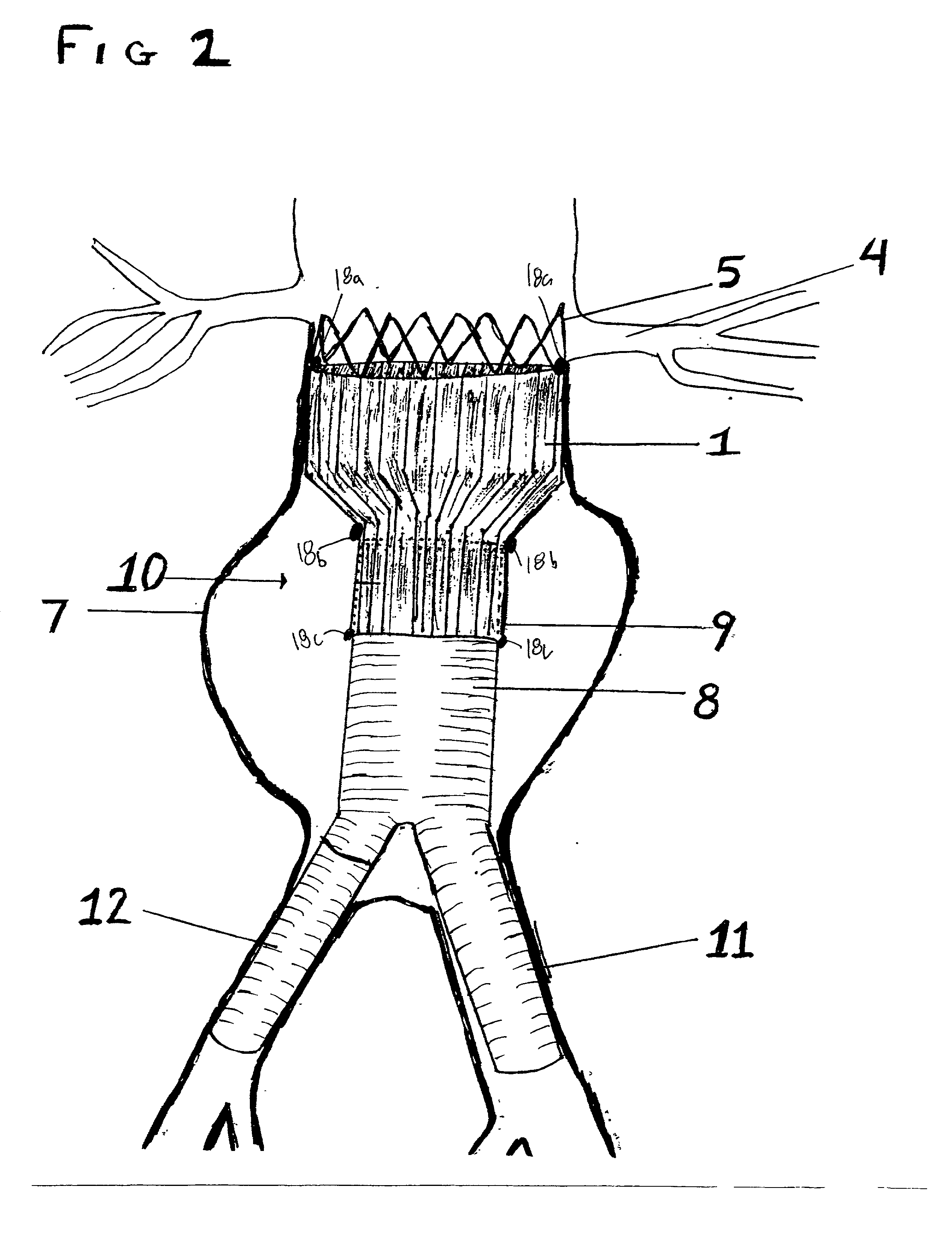 Tapered endovascular stent graft and method of treating abdominal aortic aneurysms and distal iliac aneurysms