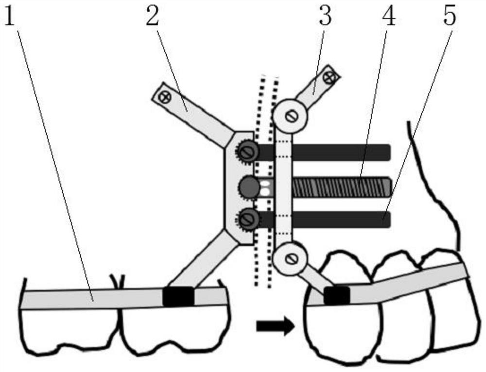 A Direction-Adjustable Anterior Maxillary Retractor and Its Clinical Application