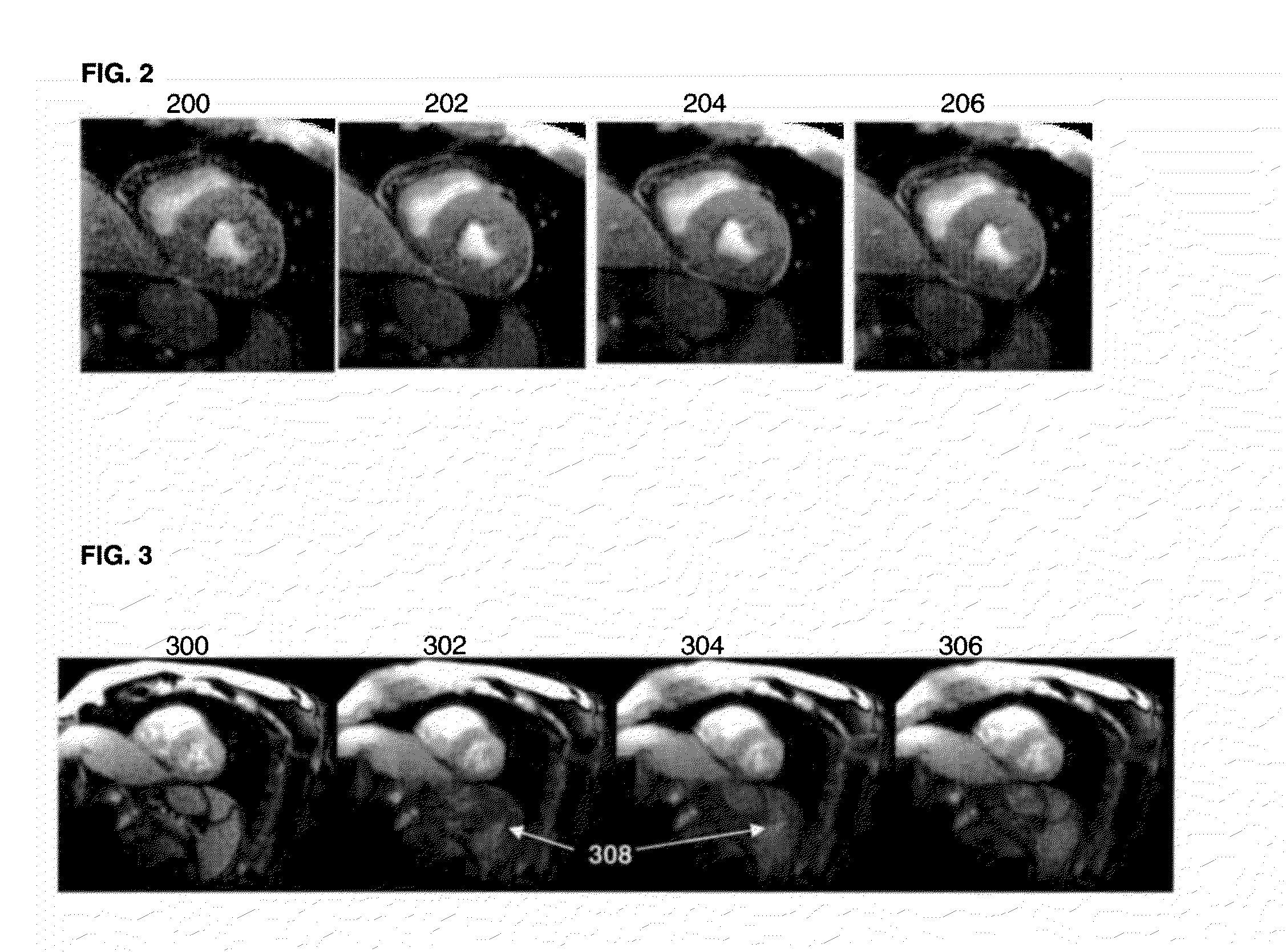 Method and system for retrospective image combination under minimal total deformation constrain for free-breathing cardiac magnetic resonance imaging with motion correction