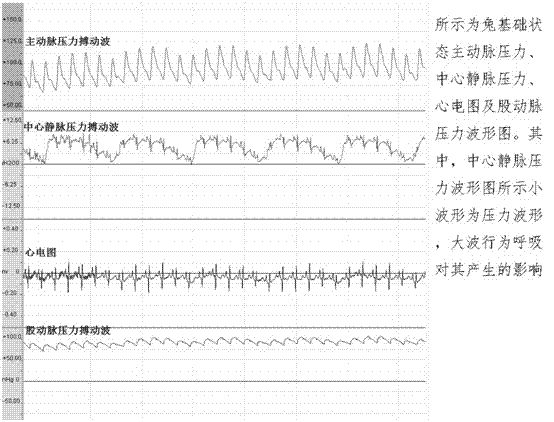 Aortic intracavitary double-horizontal-sacculus blockage pressurized infusion system