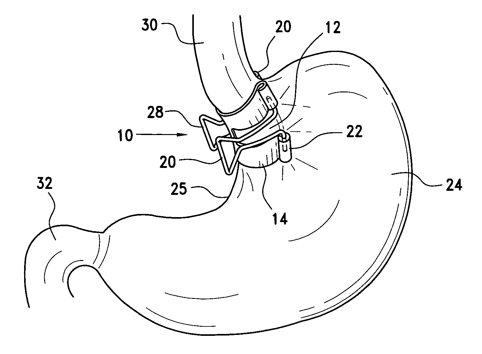 Method and clamp for gastric reduction surgery