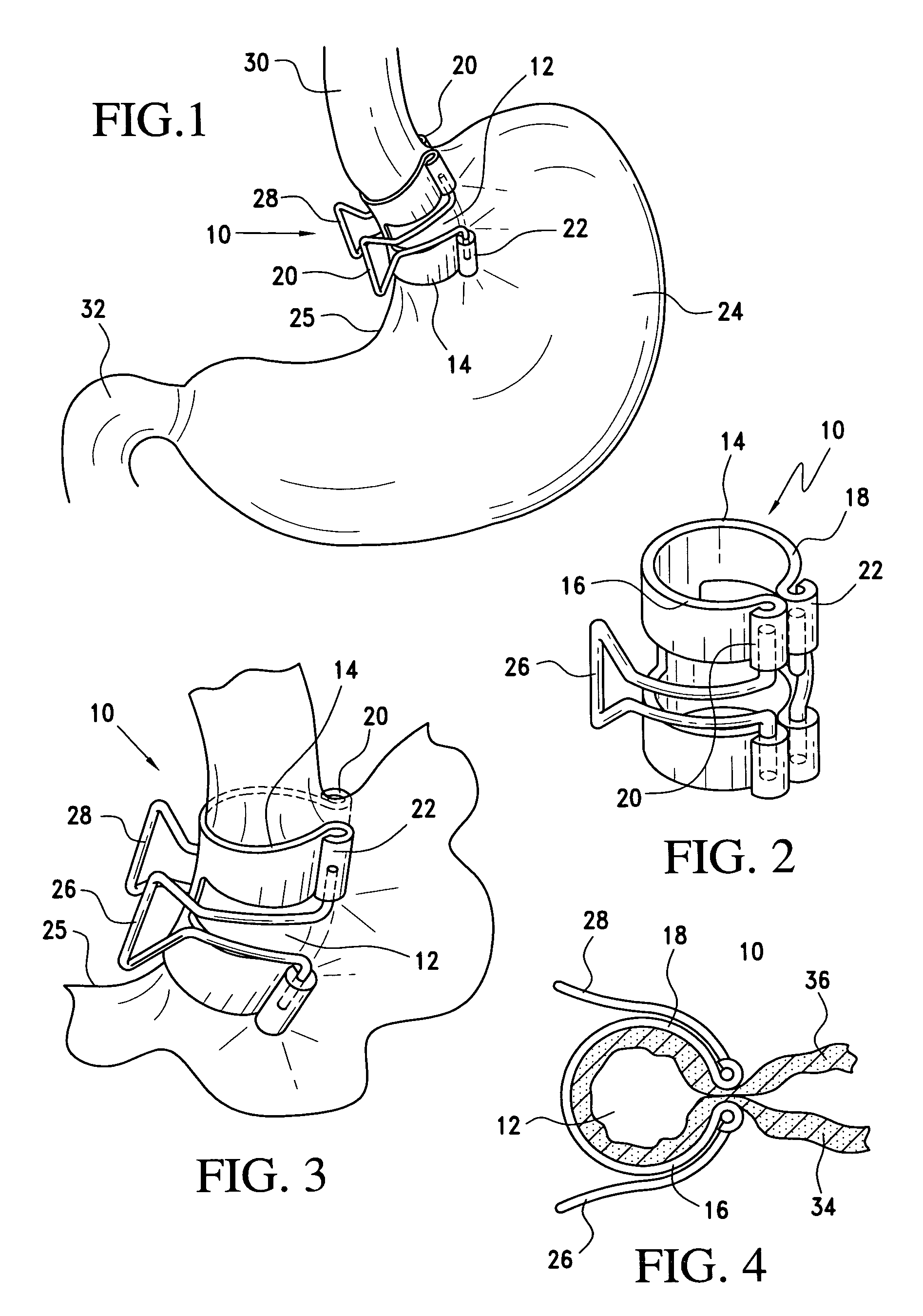 Method and clamp for gastric reduction surgery