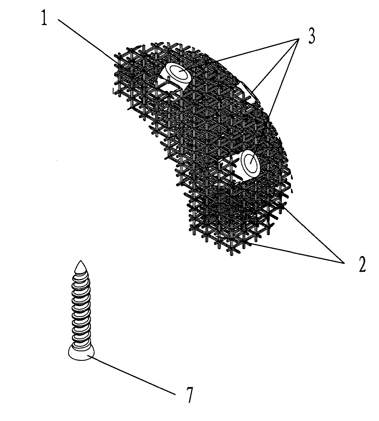 Acetabular bone deformity filler