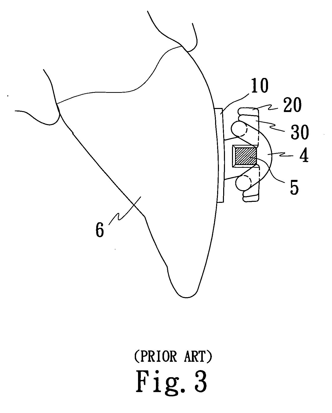 Tooth orthopedic appliance