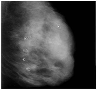 Lesion area quantification method based on mammary gland molybdenum target image