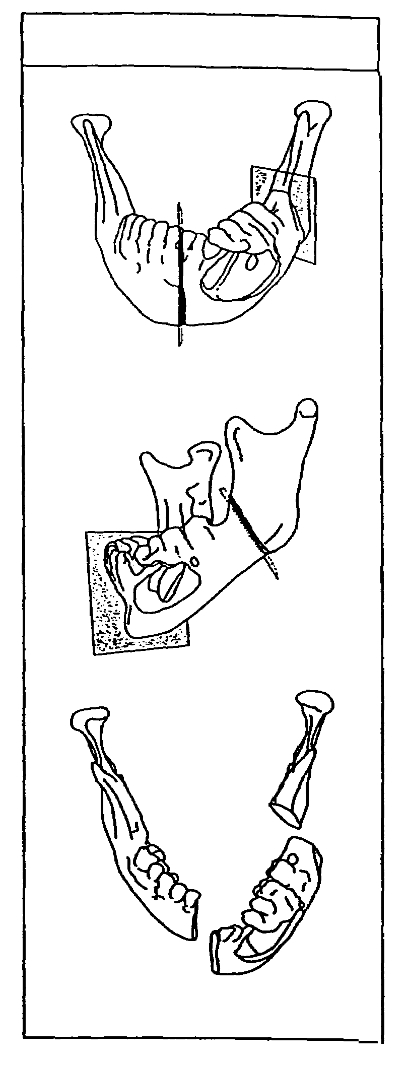 Method for contouring bone reconstruction plates