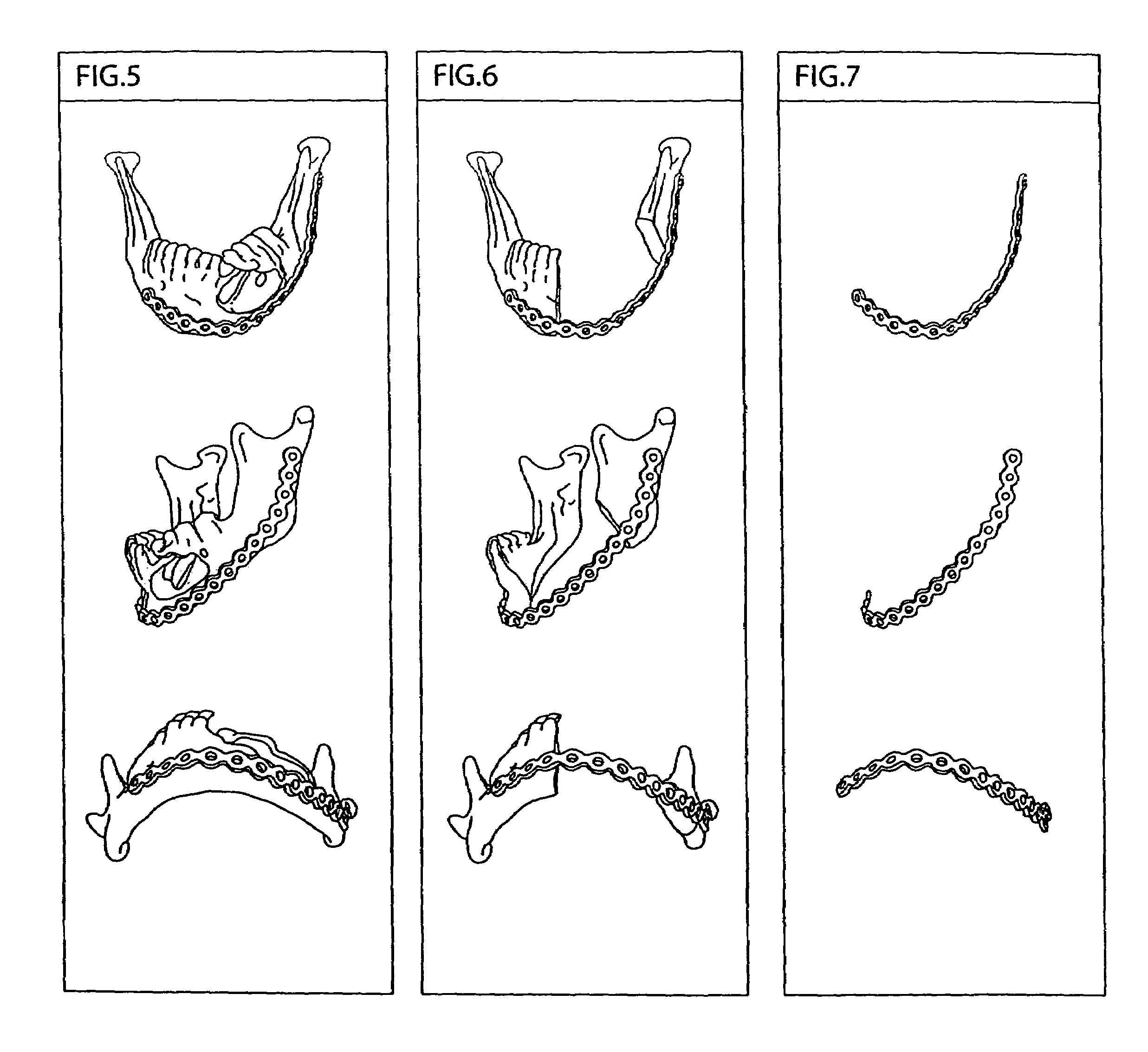 Method for contouring bone reconstruction plates