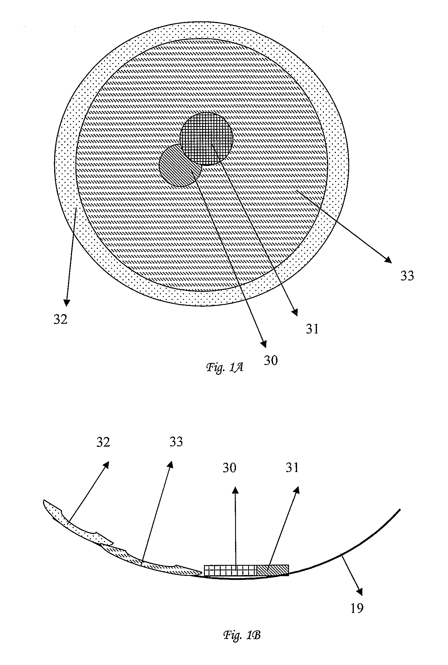 Intra-Ocular Implant