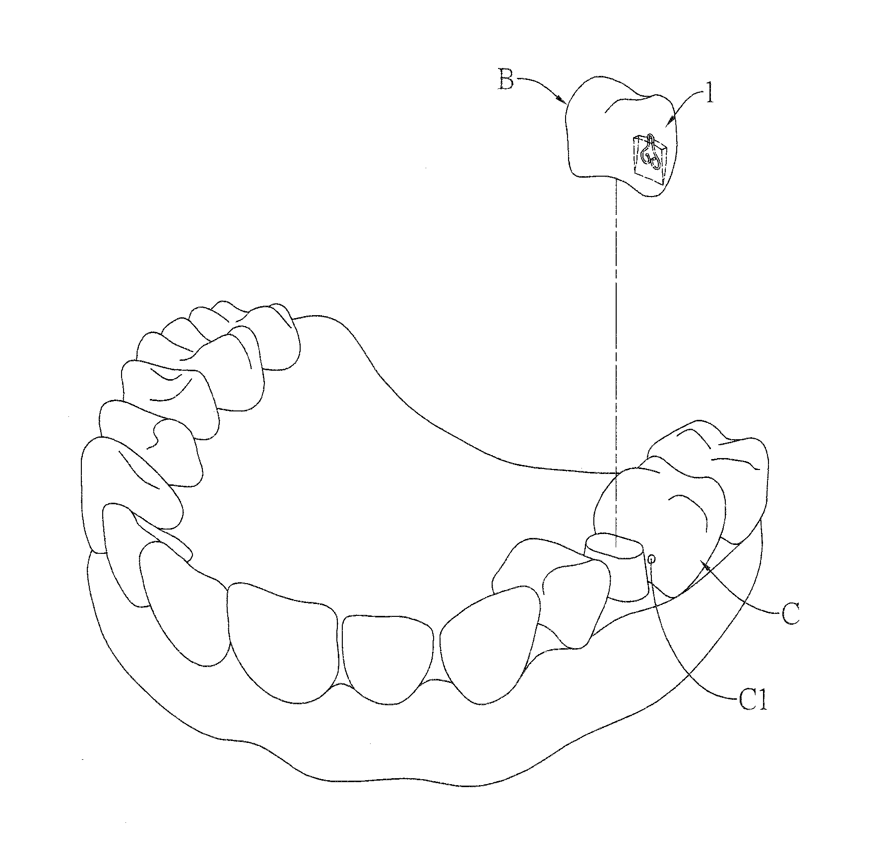 Spring clip mounted to withdrawable artificial tooth and removable artificial tooth assembled with same