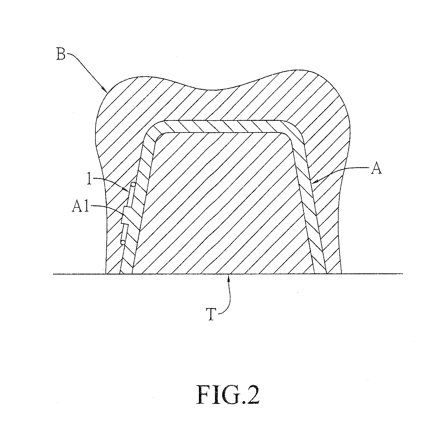 Spring clip mounted to withdrawable artificial tooth and removable artificial tooth assembled with same