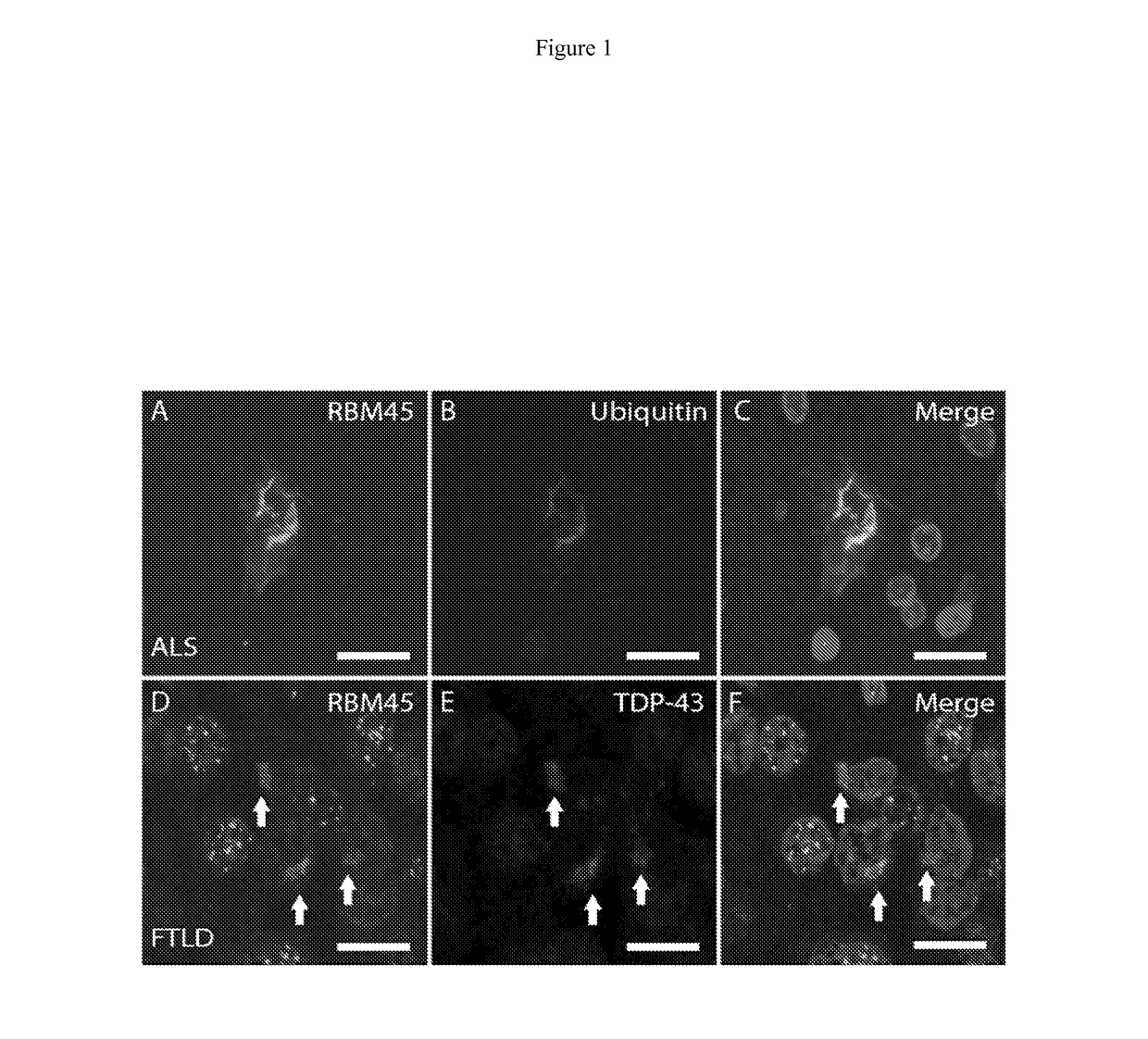 Nuclear stress response in motor neuron disease and other neurological diseases