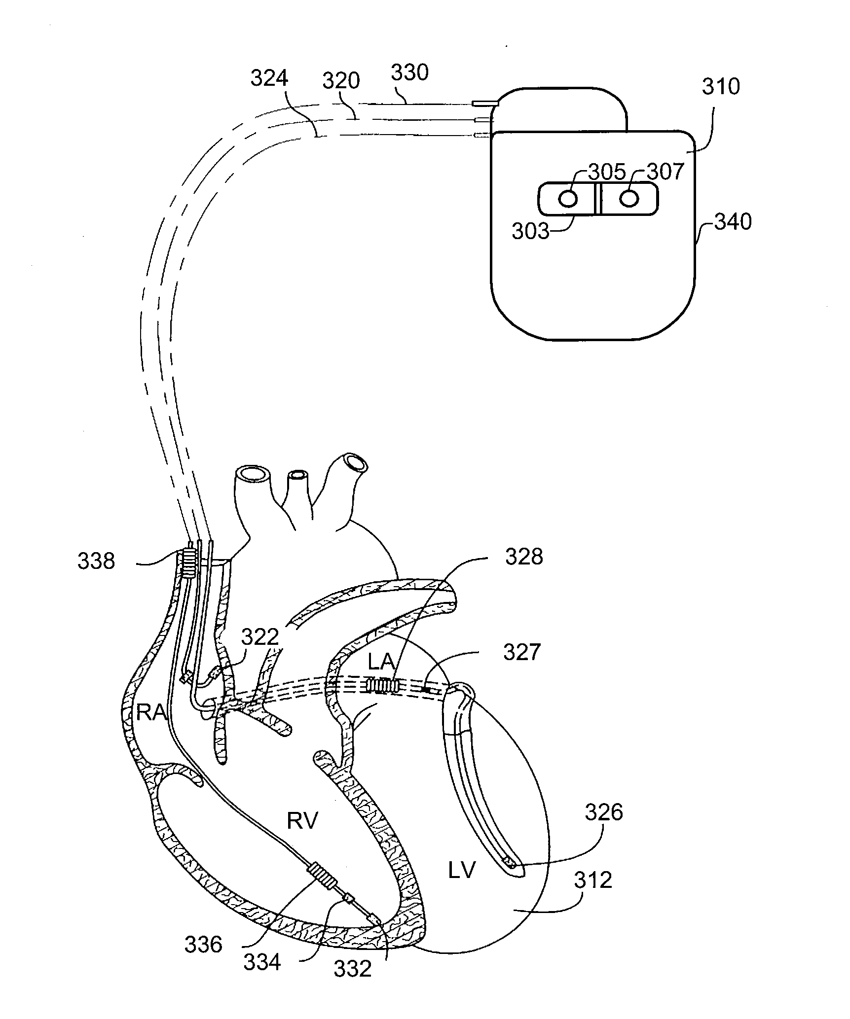 Method and System for Hemodynamic Optimization Using Plethysmography