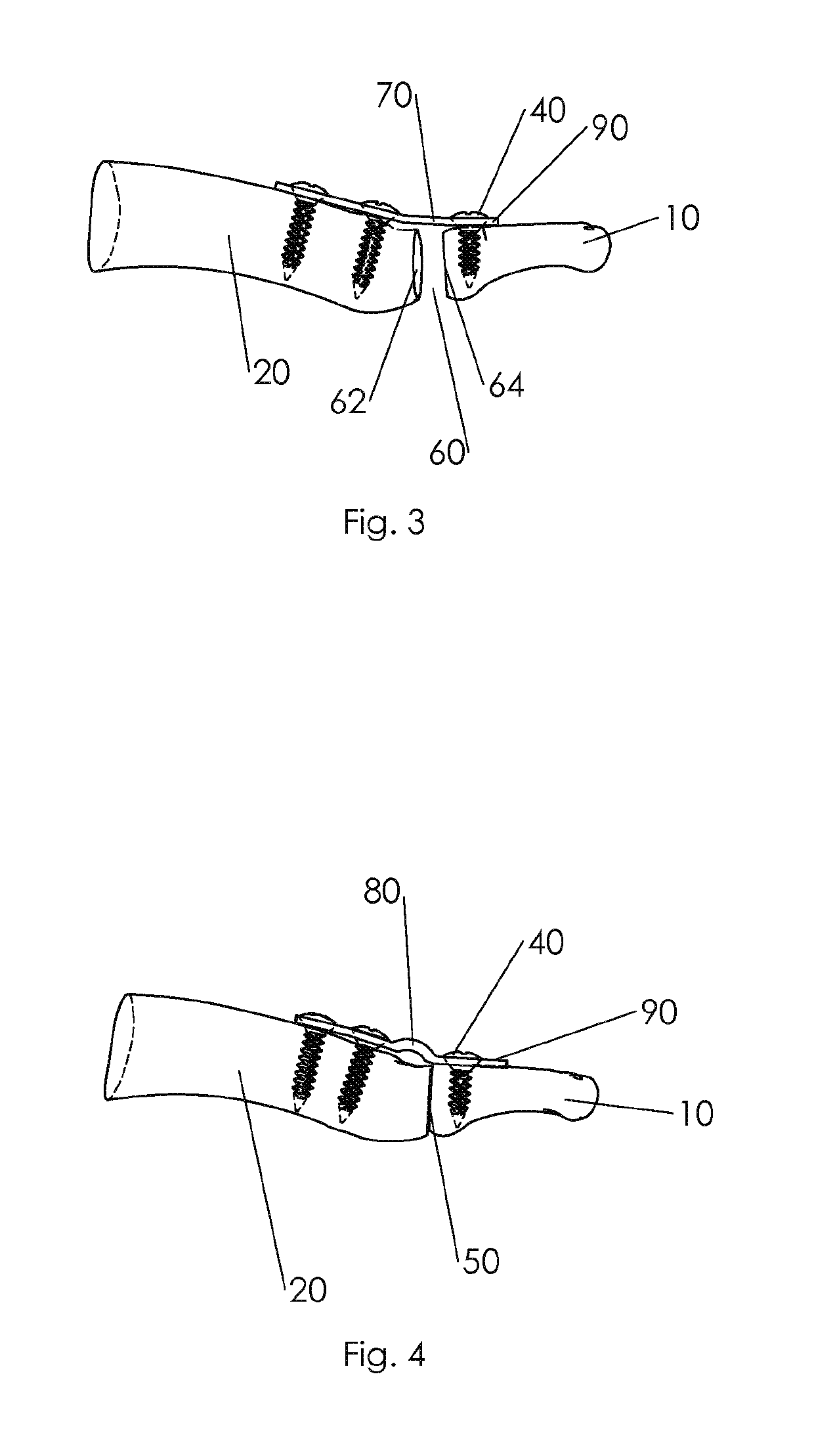 Shape changing bone implant and method of use for enhancing healing