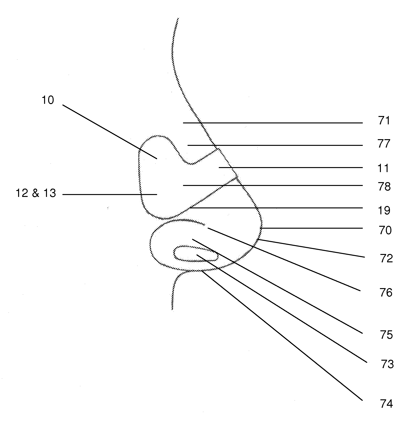 Simplified nasal dilator