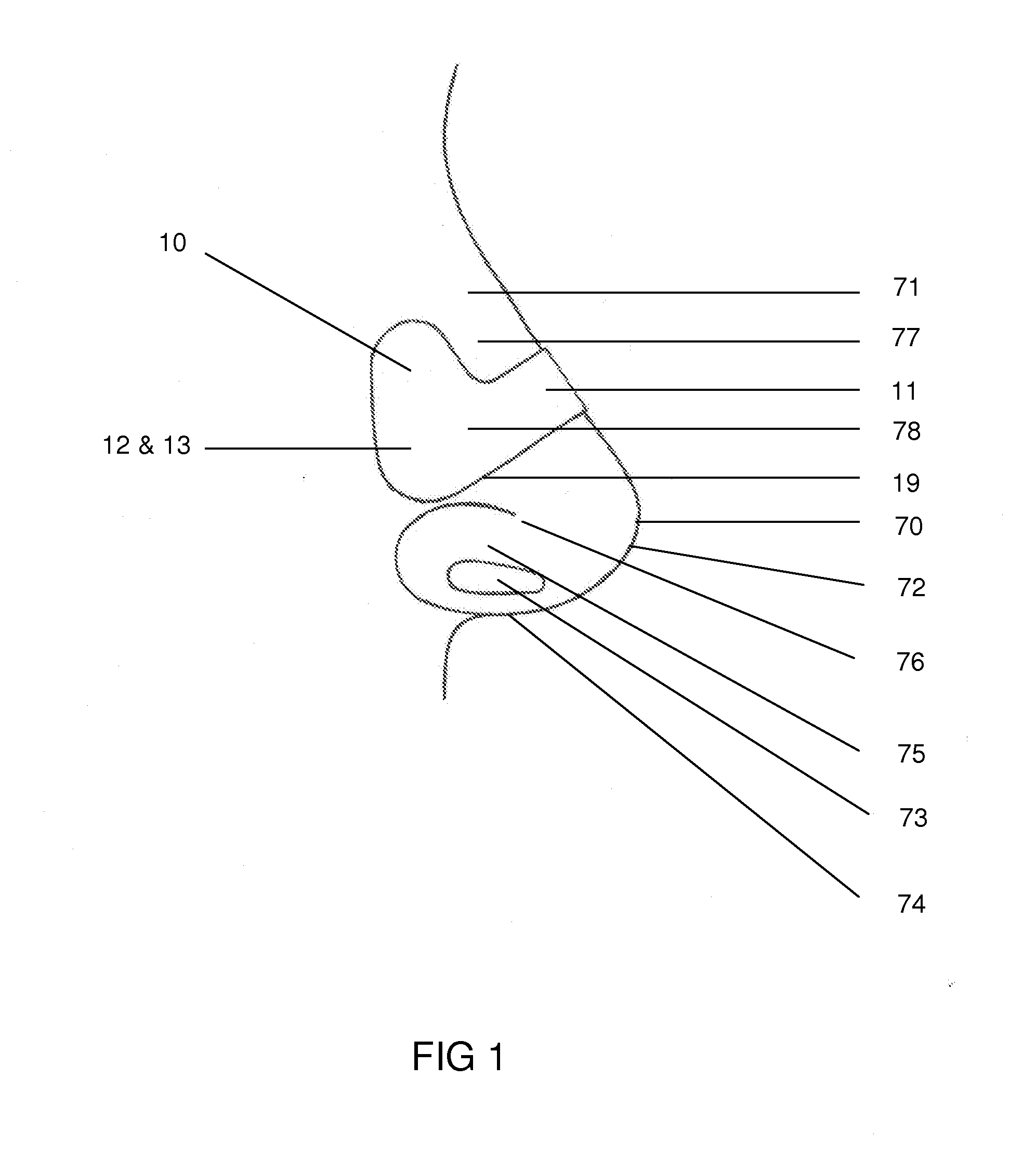 Simplified nasal dilator