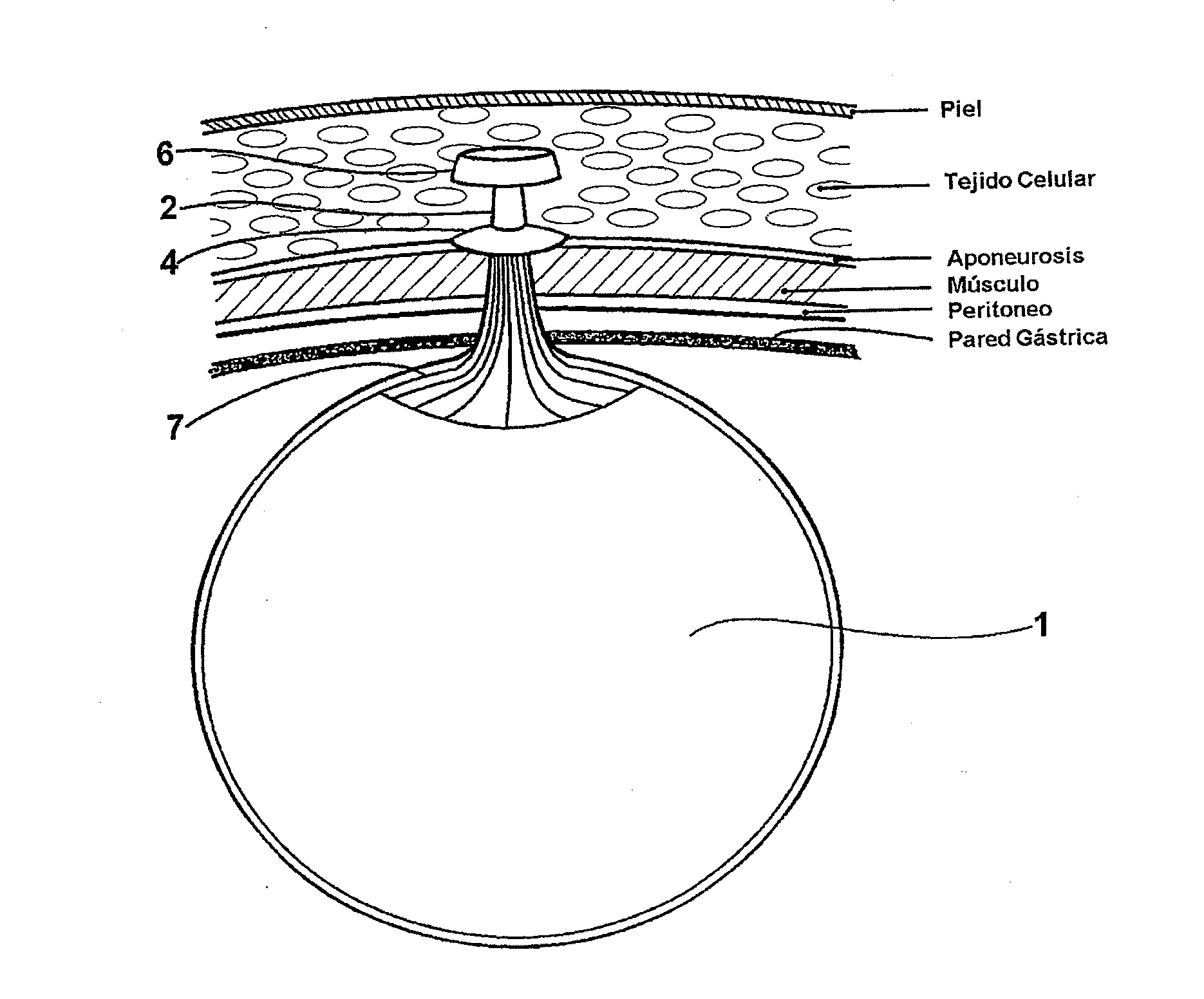 Intragastric balloon assembly