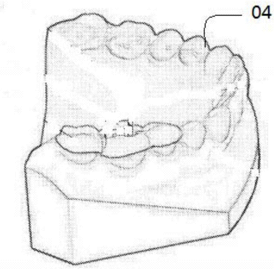 Treatment guide plate for root canal treatment and preparation method thereof