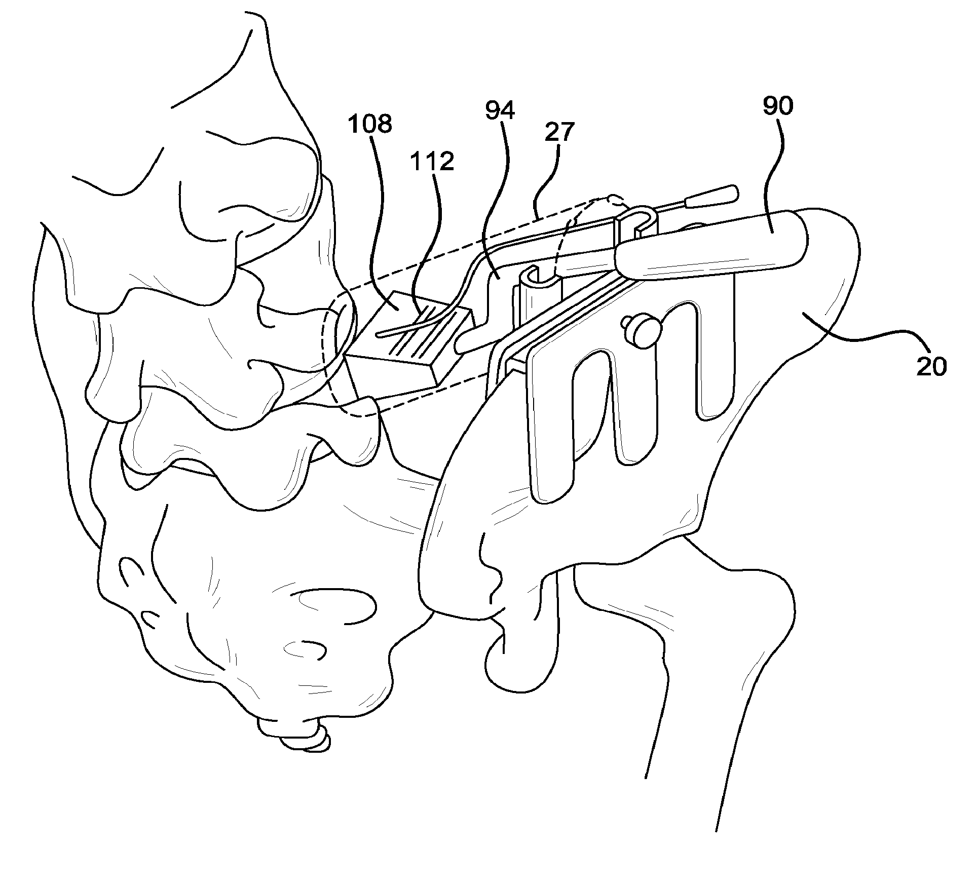 Method and apparatus for laterally accessing an intervertebral disc space