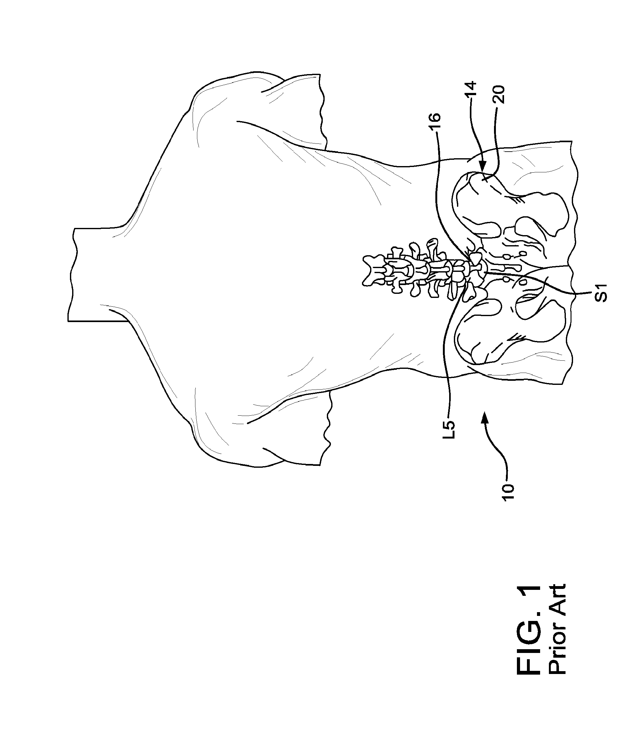 Method and apparatus for laterally accessing an intervertebral disc space