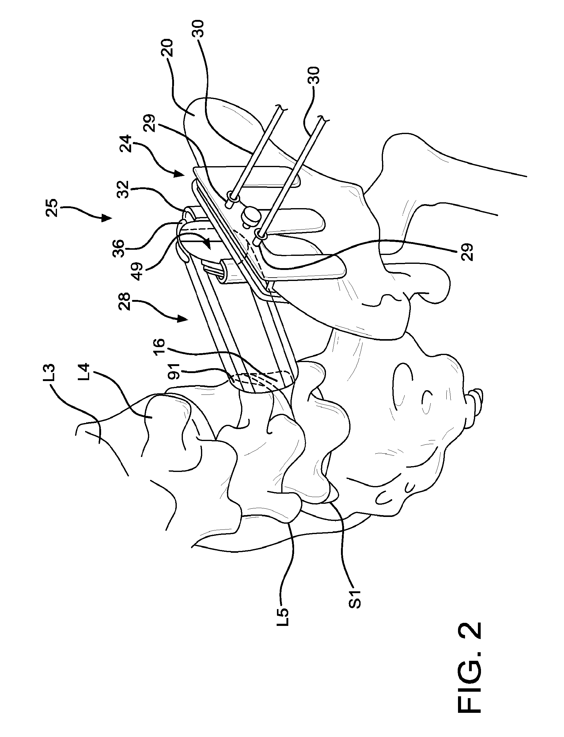 Method and apparatus for laterally accessing an intervertebral disc space