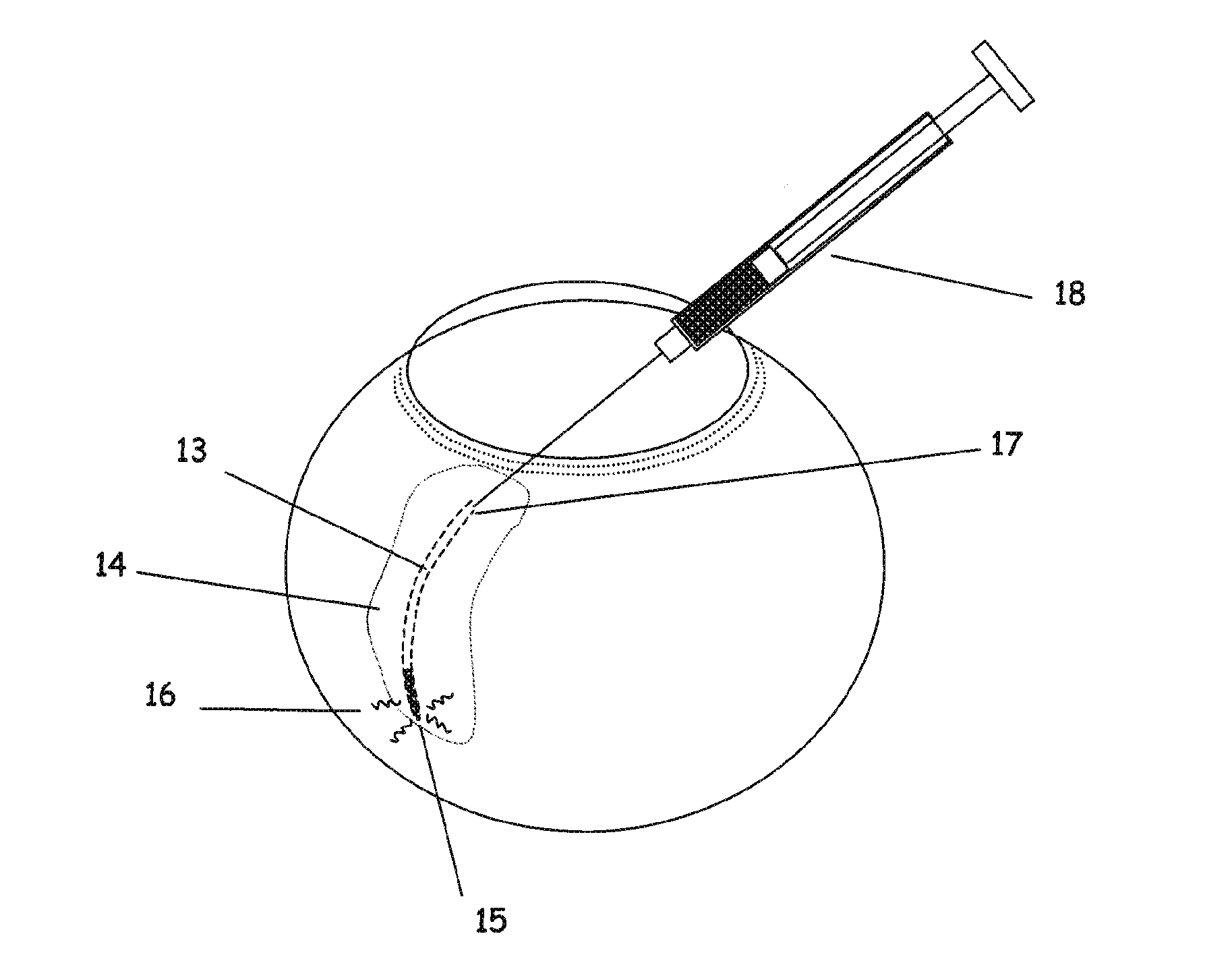 Apparatus and method for ocular treatment