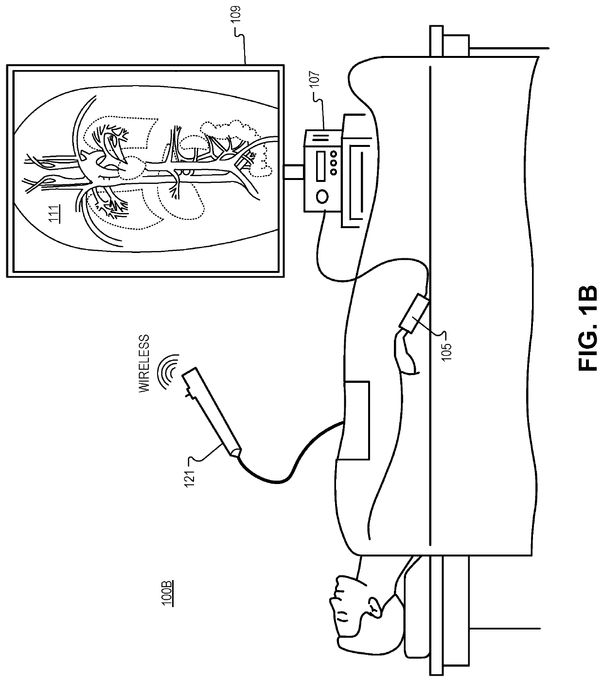 Detection of blood vessels