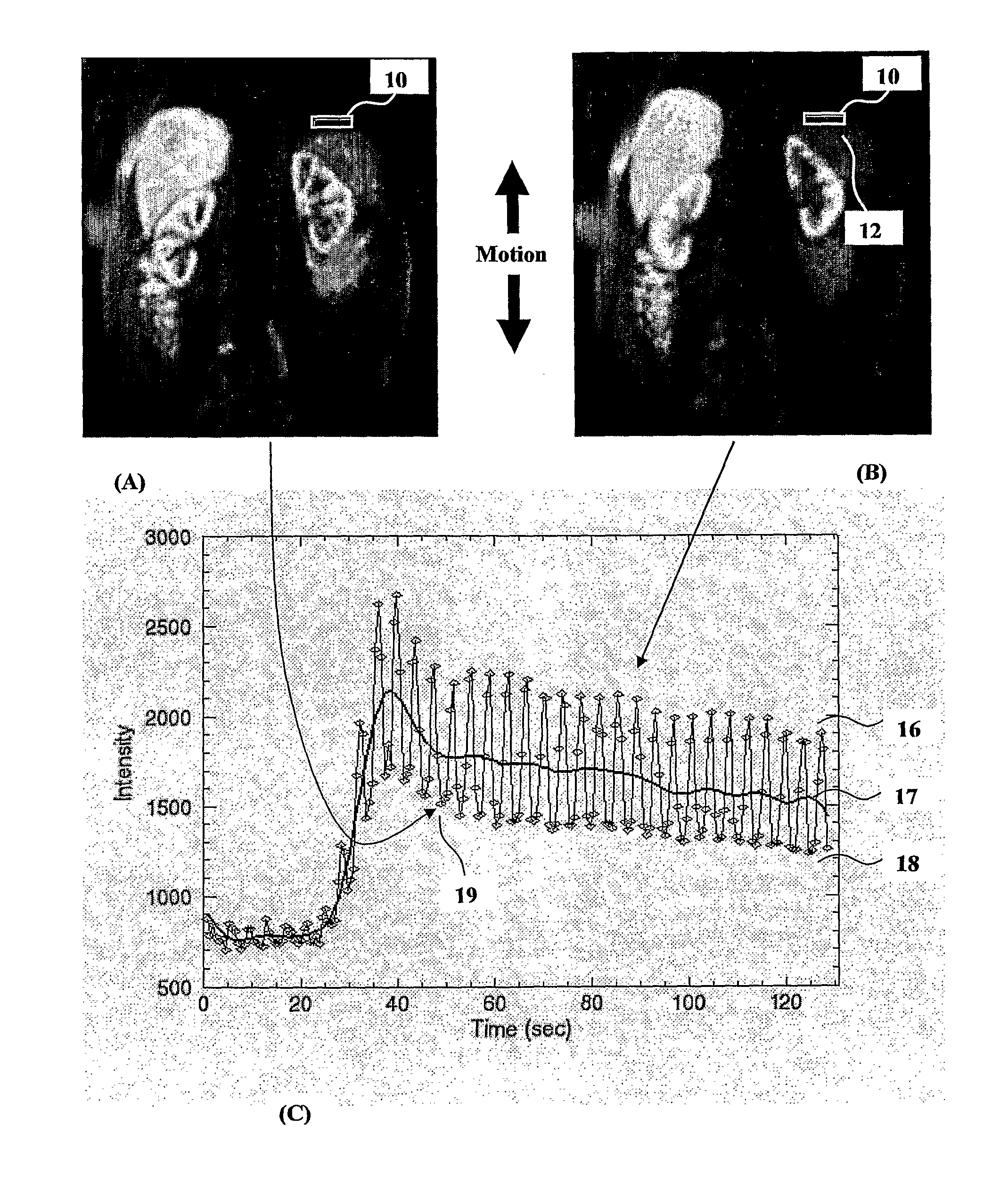 Method and system of motion artefact compensation in a subject