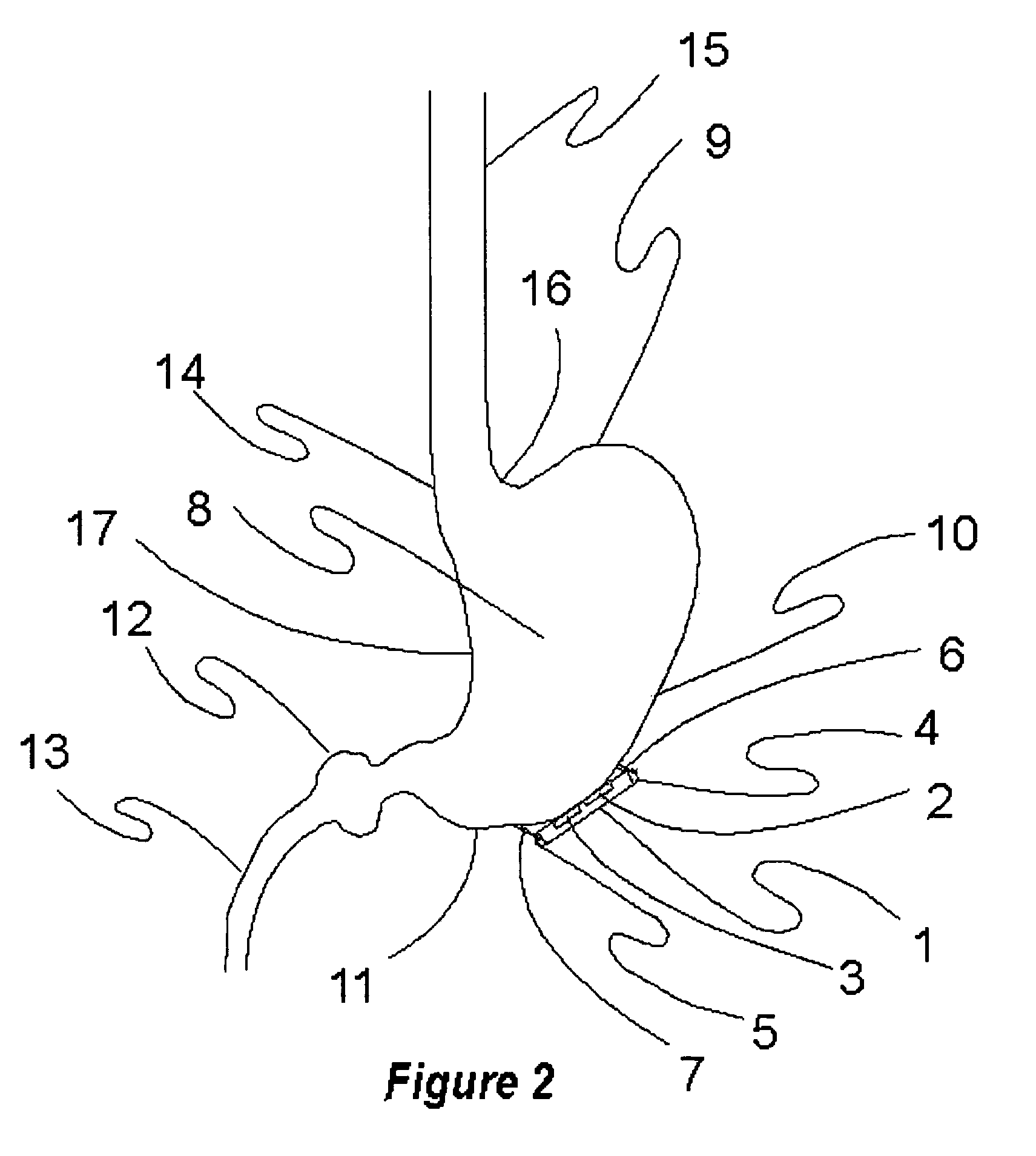 Method and apparatus for neuromodulation and physiologic modulation for the treatment of metabolic and neuropsychiatric disease