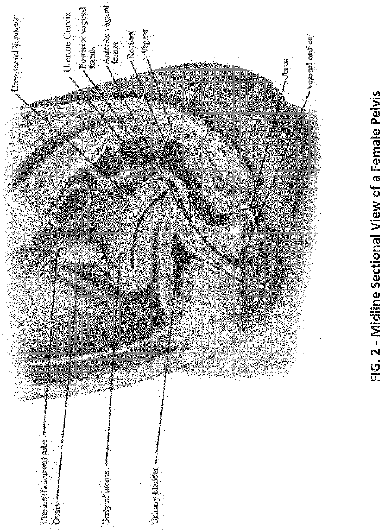 Intravaginal Electrical Stimulation Device for Treating Female Pelvic Pain