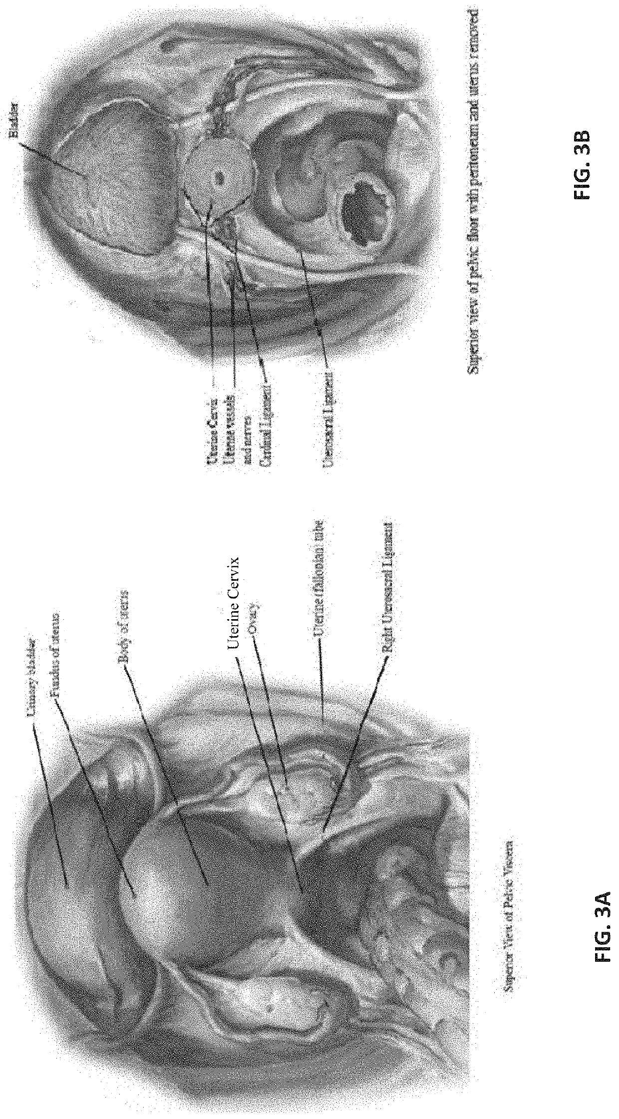 Intravaginal Electrical Stimulation Device for Treating Female Pelvic Pain