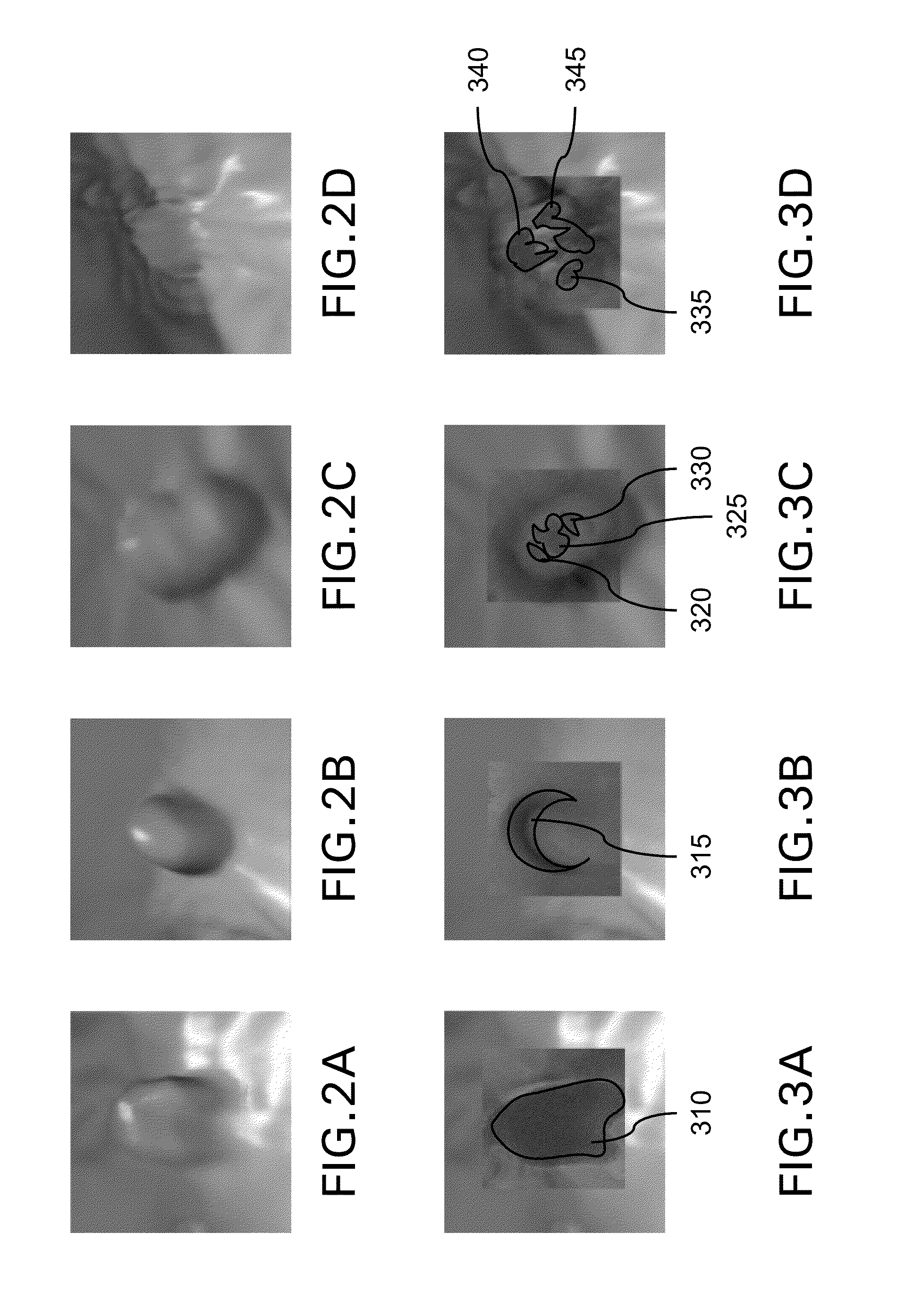 System and method for computer aided polyp detection