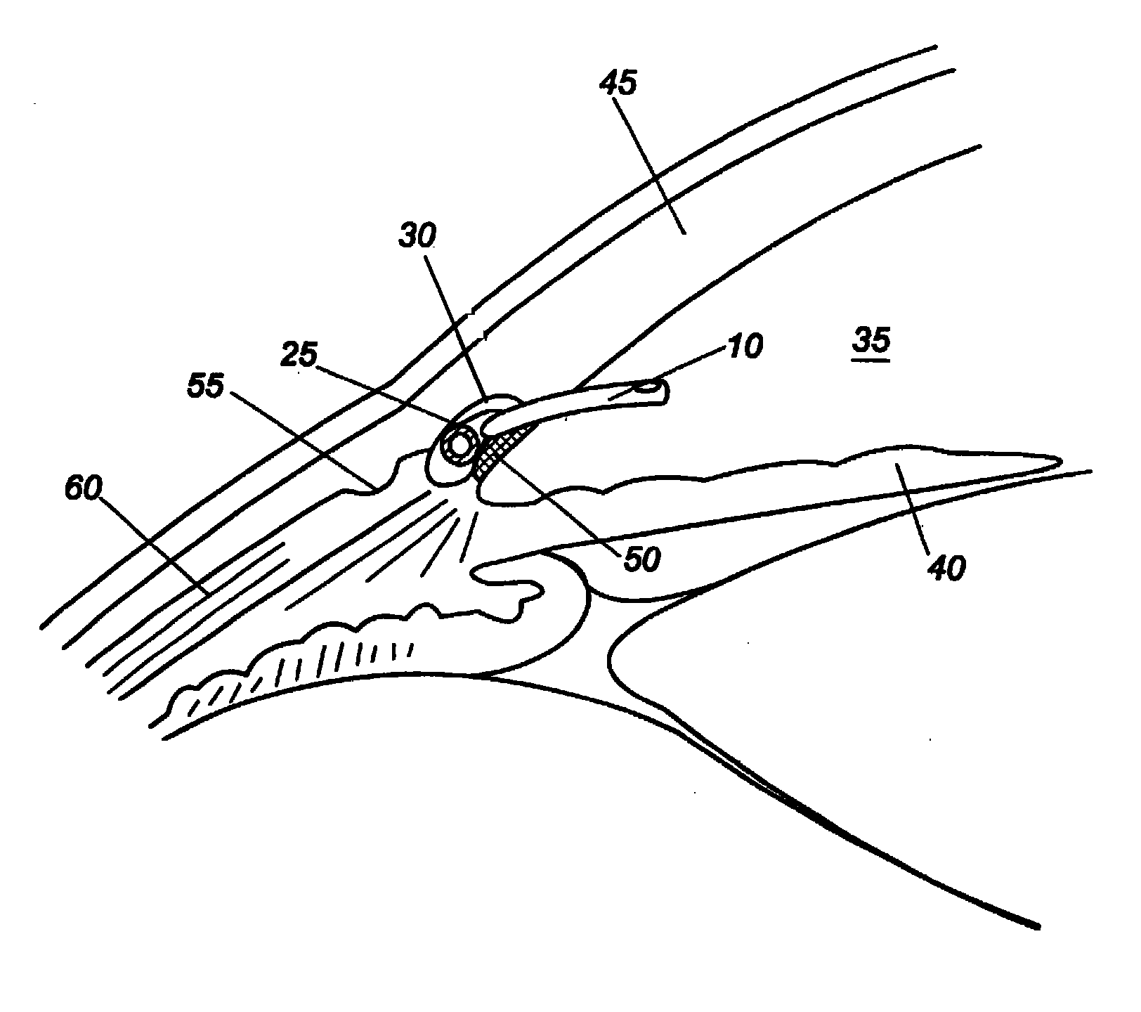 Dual drainage pathway shunt device and method for treating glaucoma